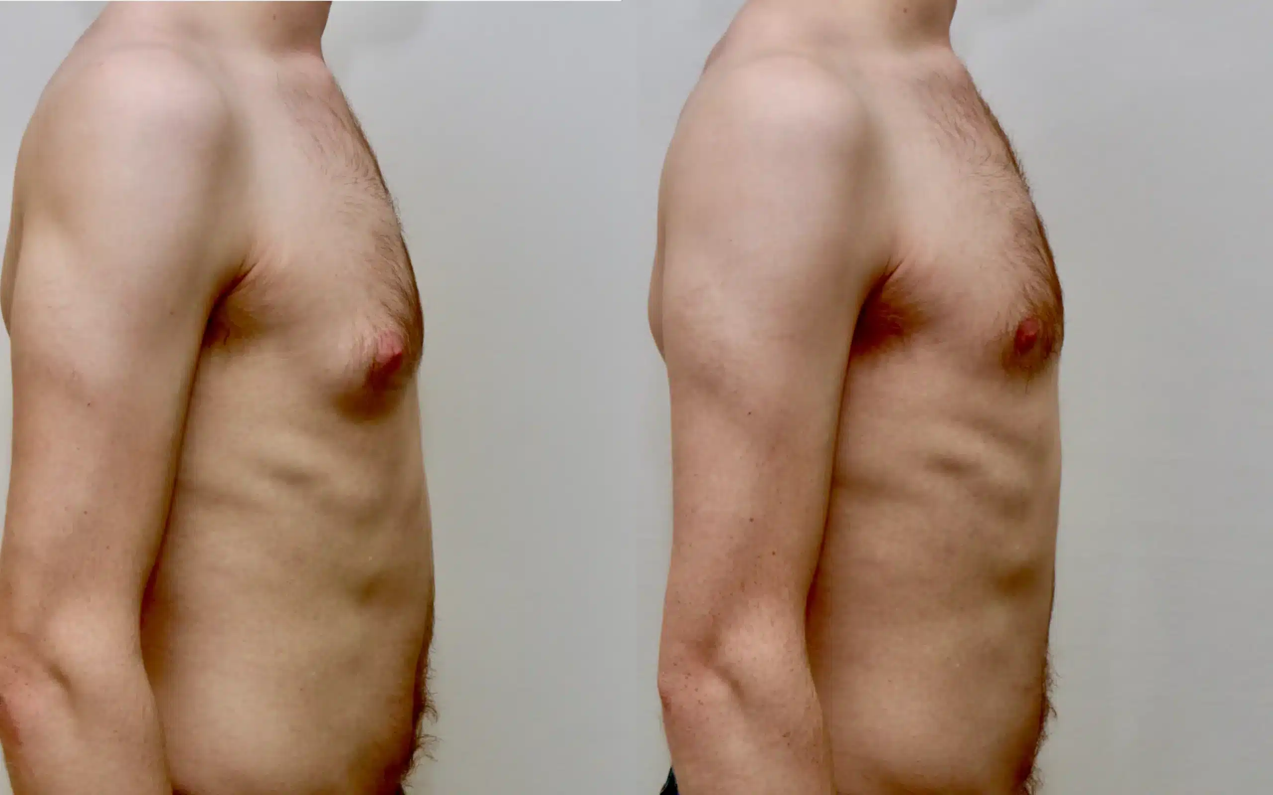 gyno surgery before and after under local anaesthesia