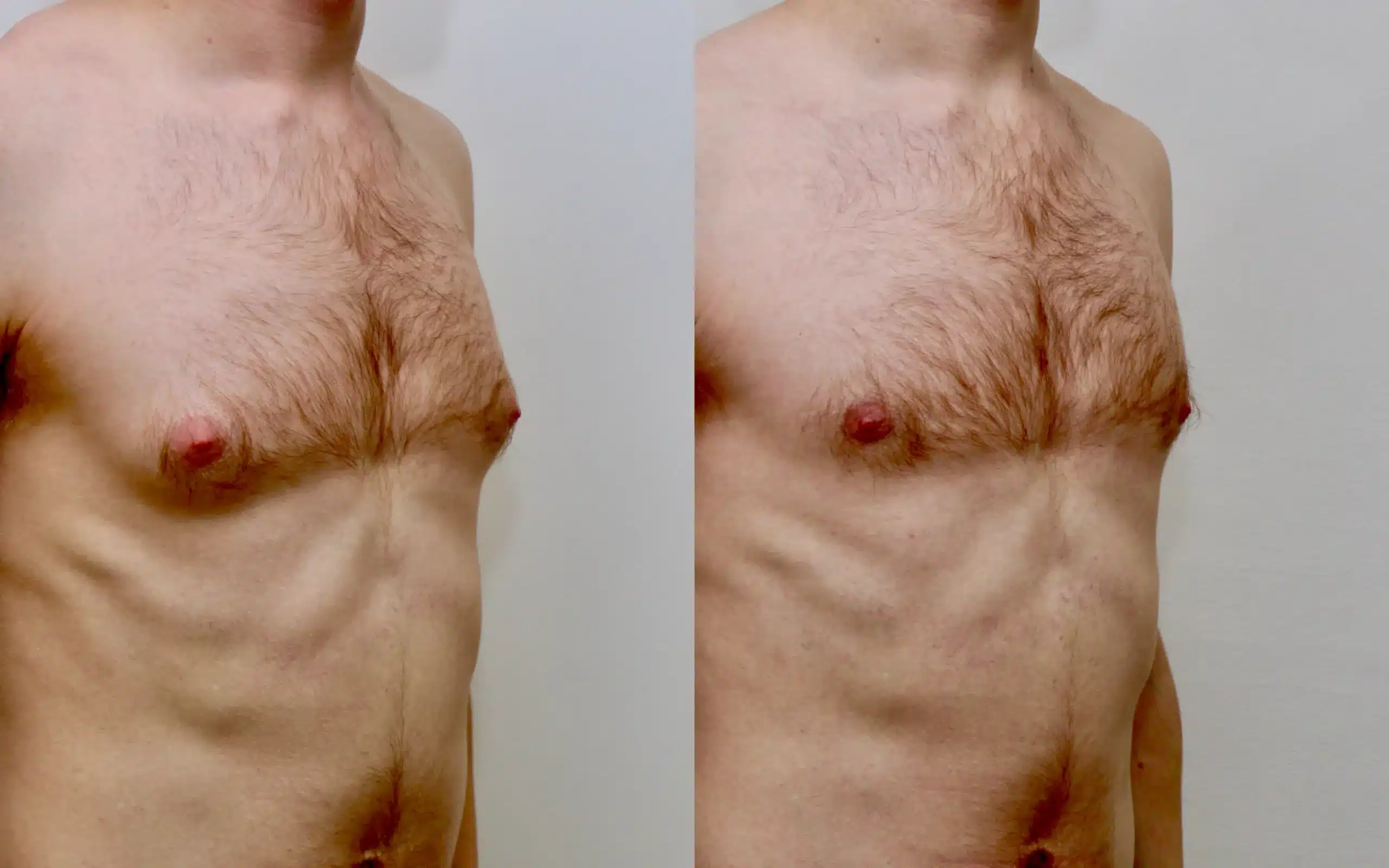 gyno surgery before and after under local anaesthesia