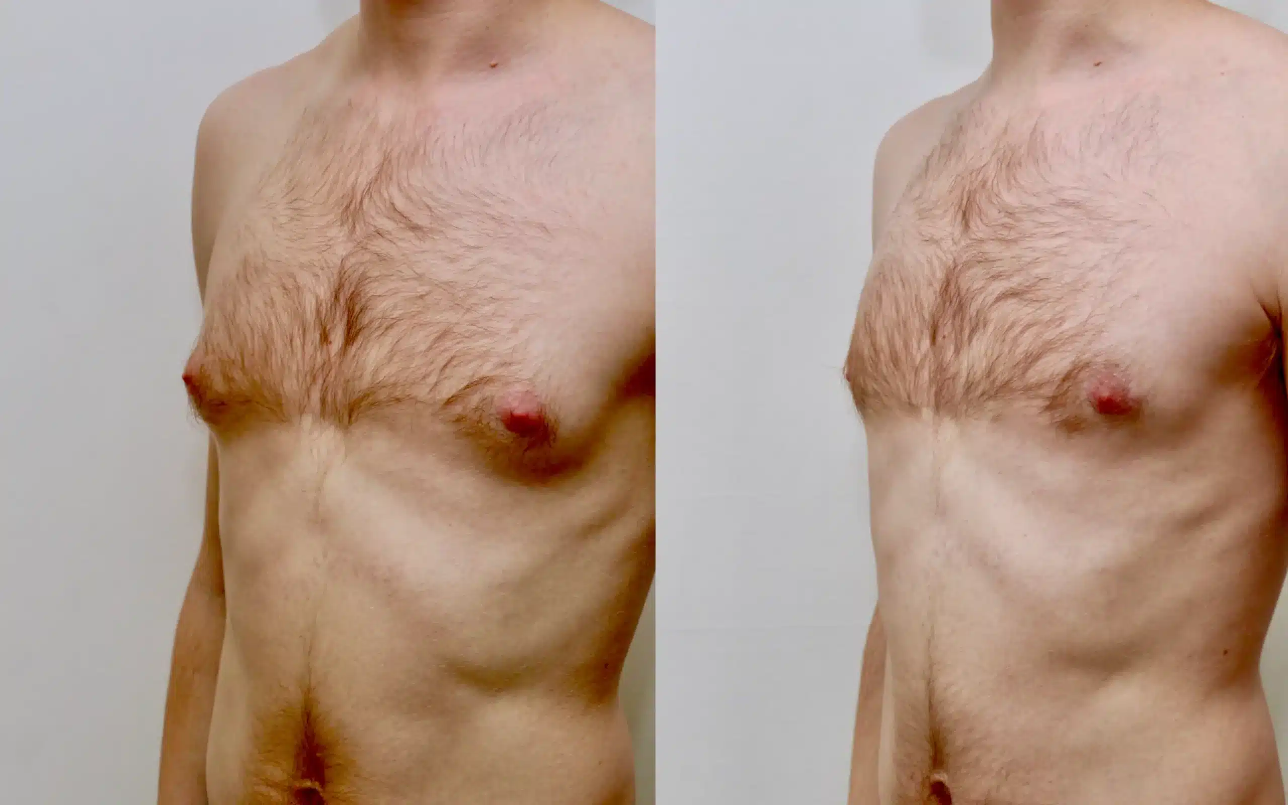 gyno surgery before and after under local anaesthesia