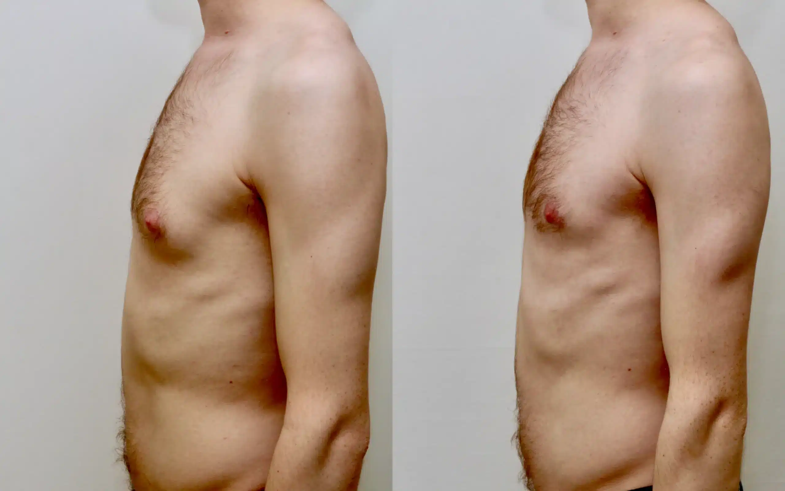 gyno surgery before and after under local anaesthesia