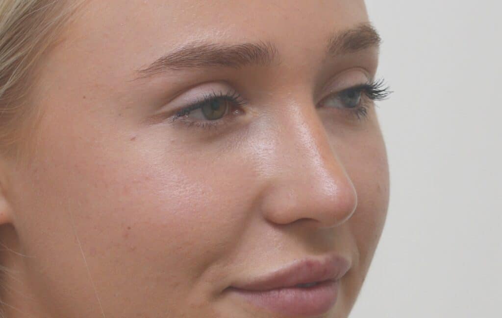 Rhinoplasty Nose Job Edinburgh Scotland Quaba Cosmetic