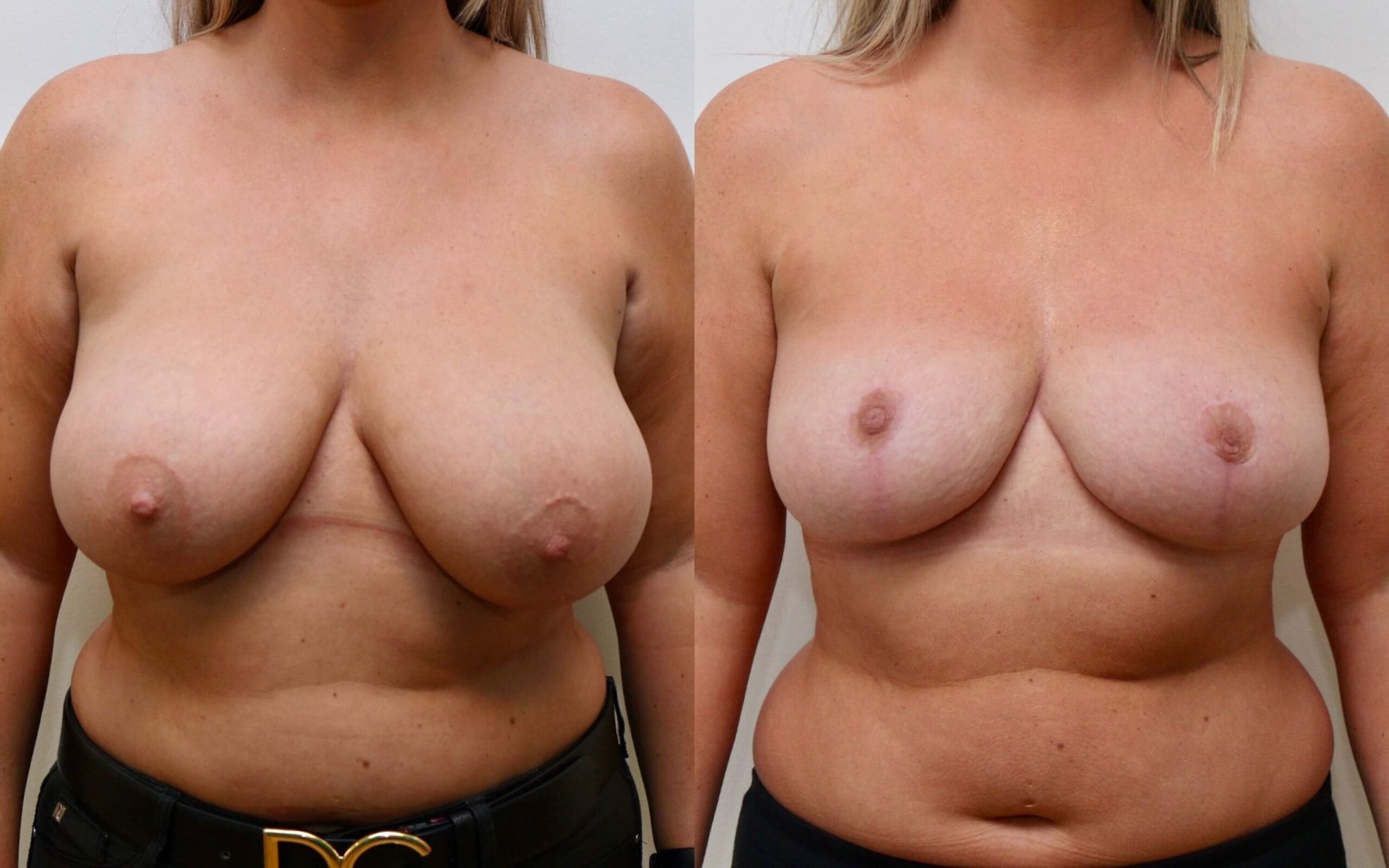 Breast uplift and correction of asymmetry