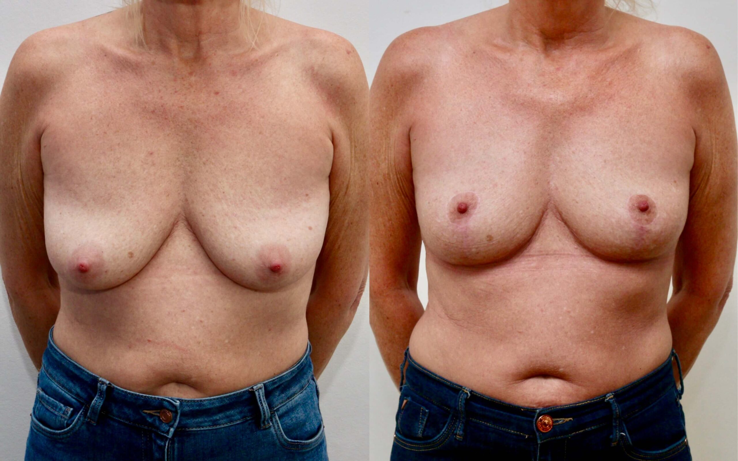 small skin only breast uplift