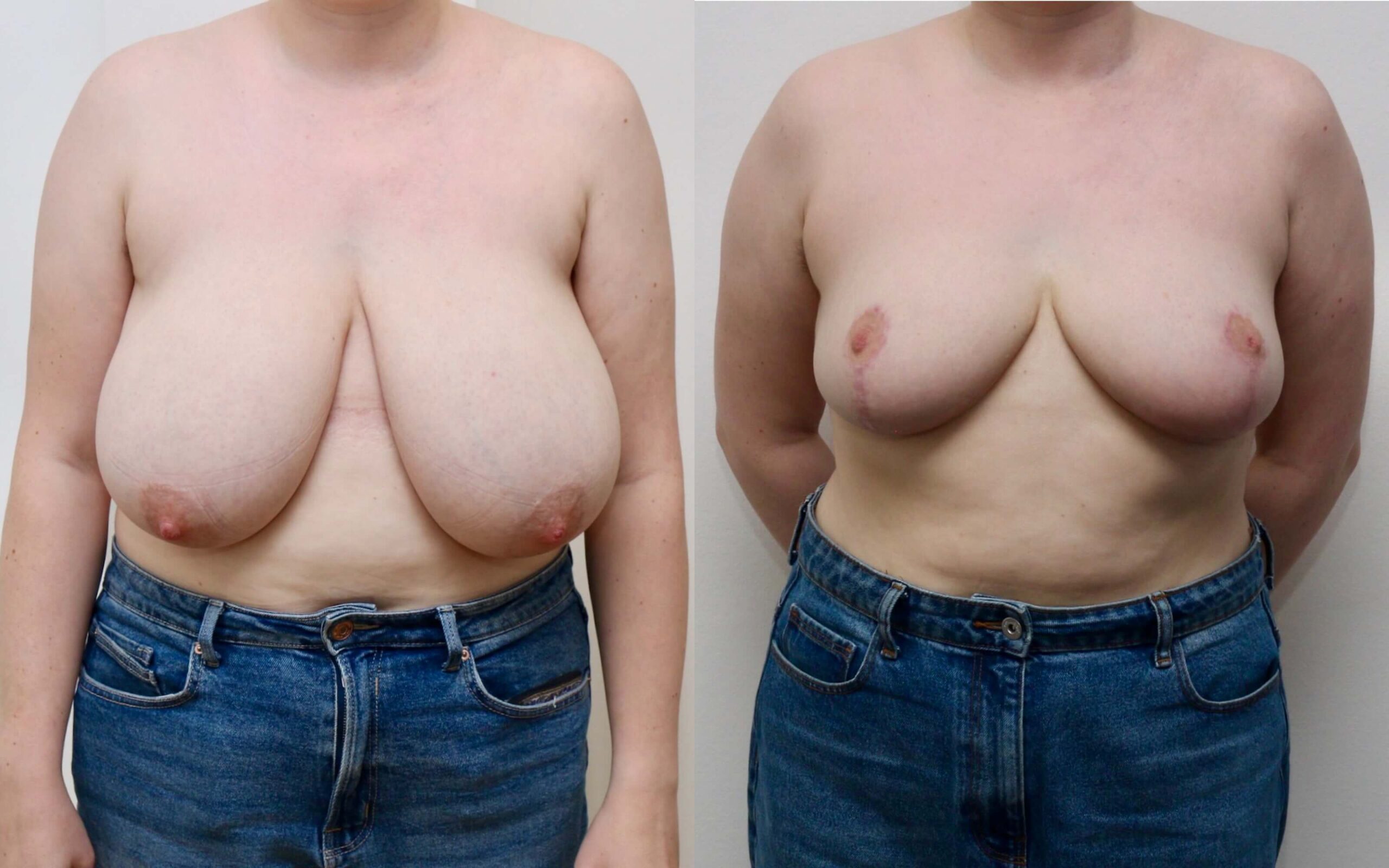 breast reduction scotland