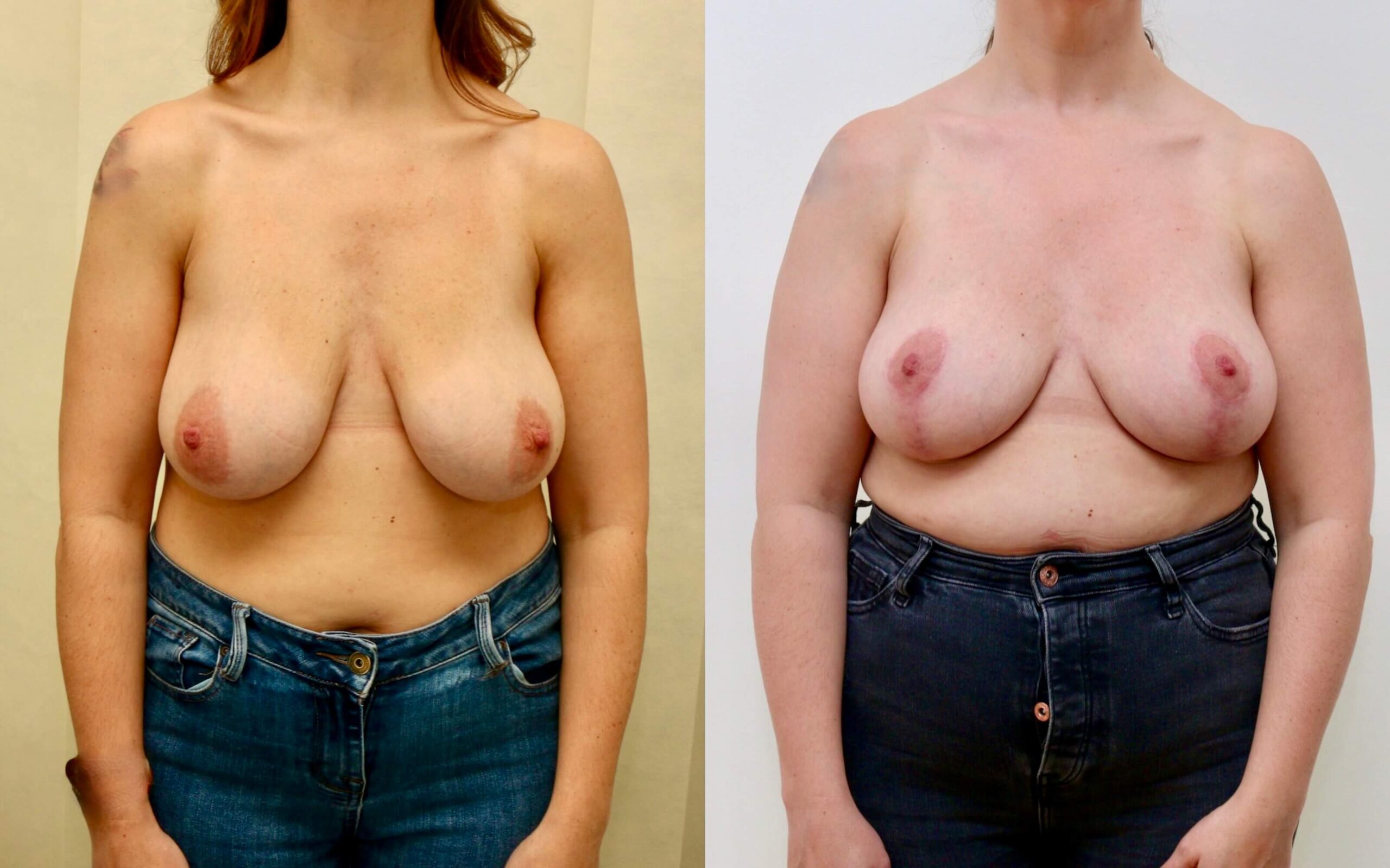 Breast uplift with small reduction