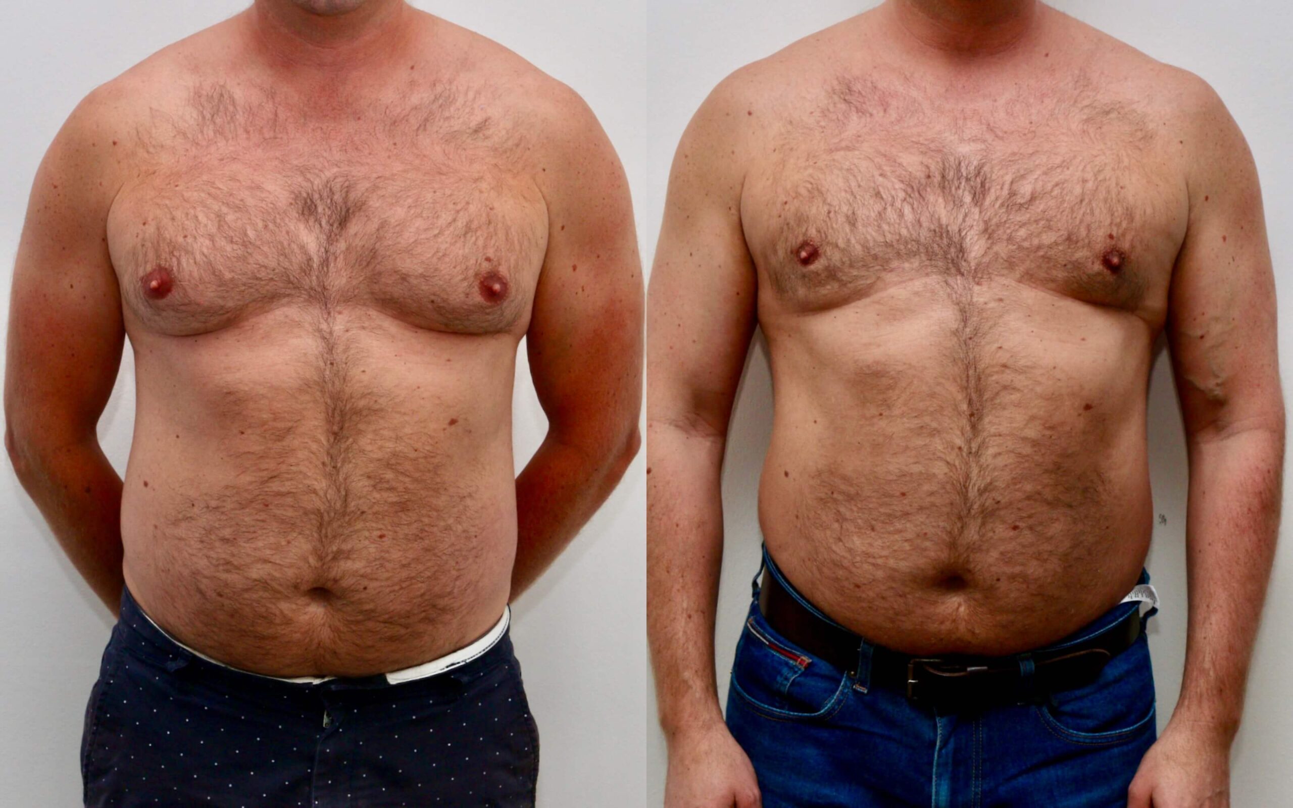 High volume liposuction for gynecomastia