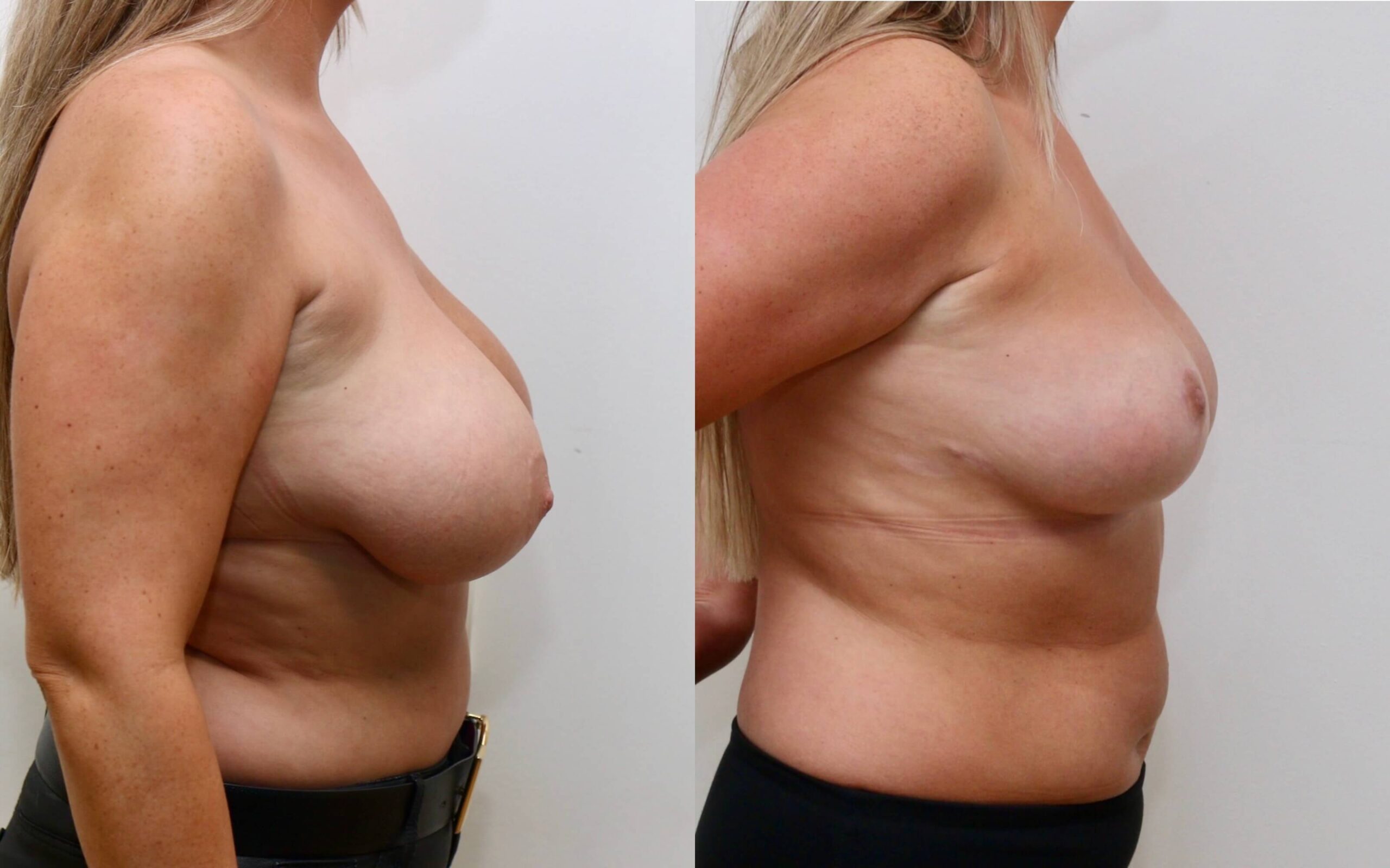 Breast uplift and correction of asymmetry