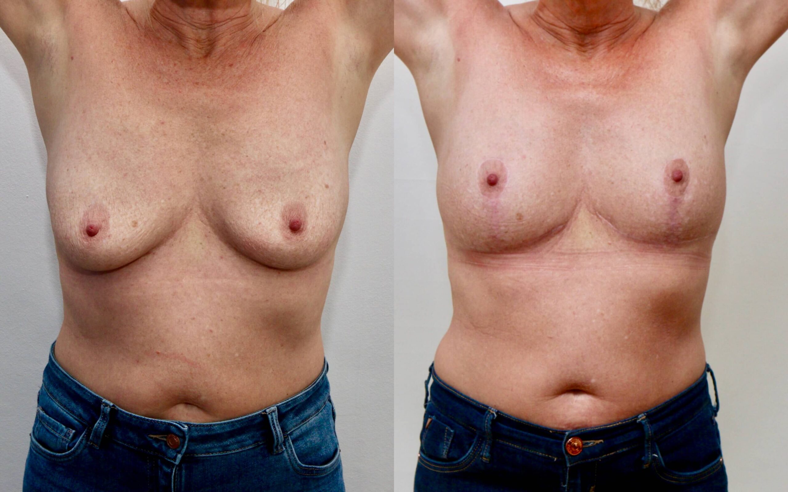 breast uplift scars