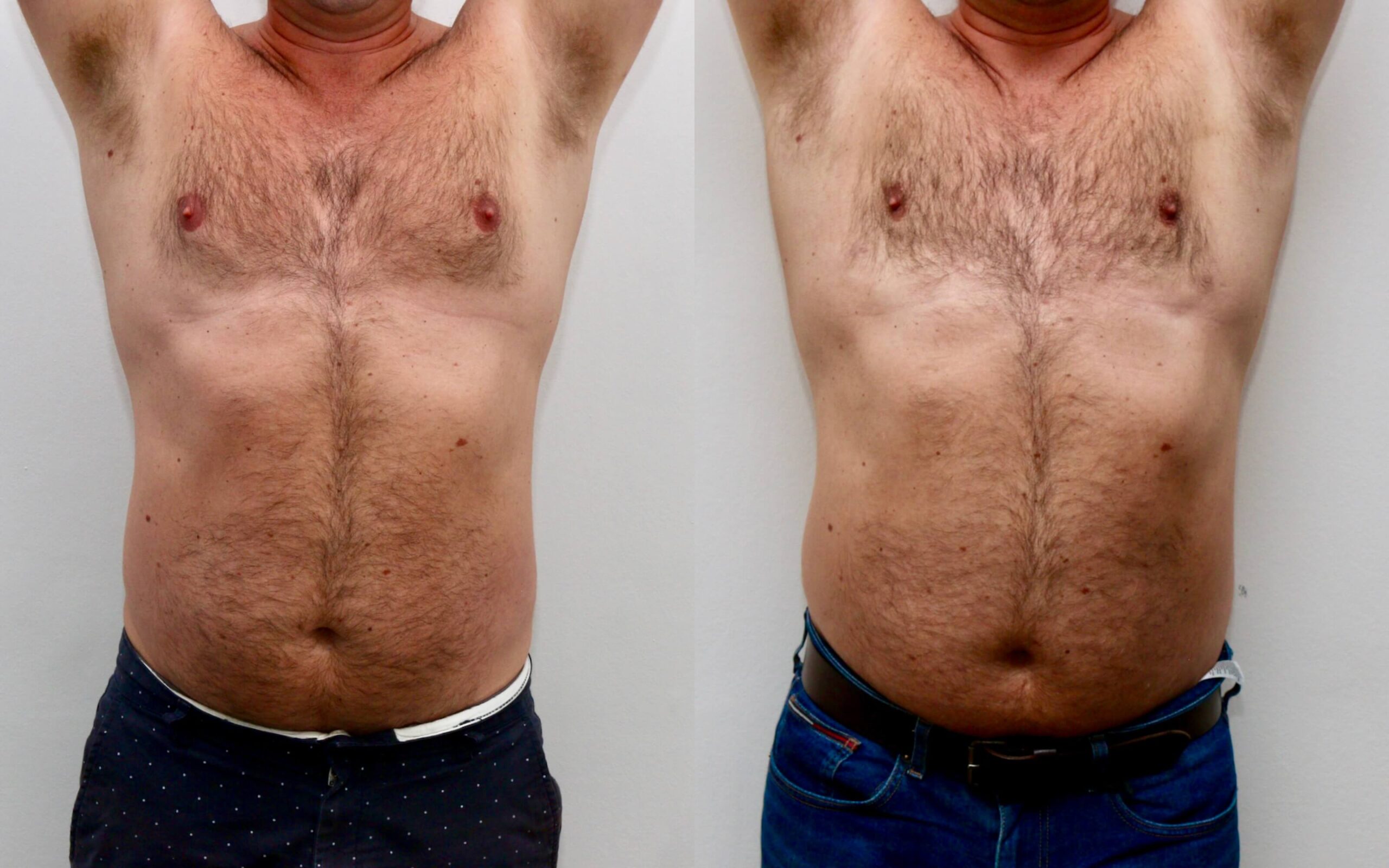 High volume liposuction for gynecomastia