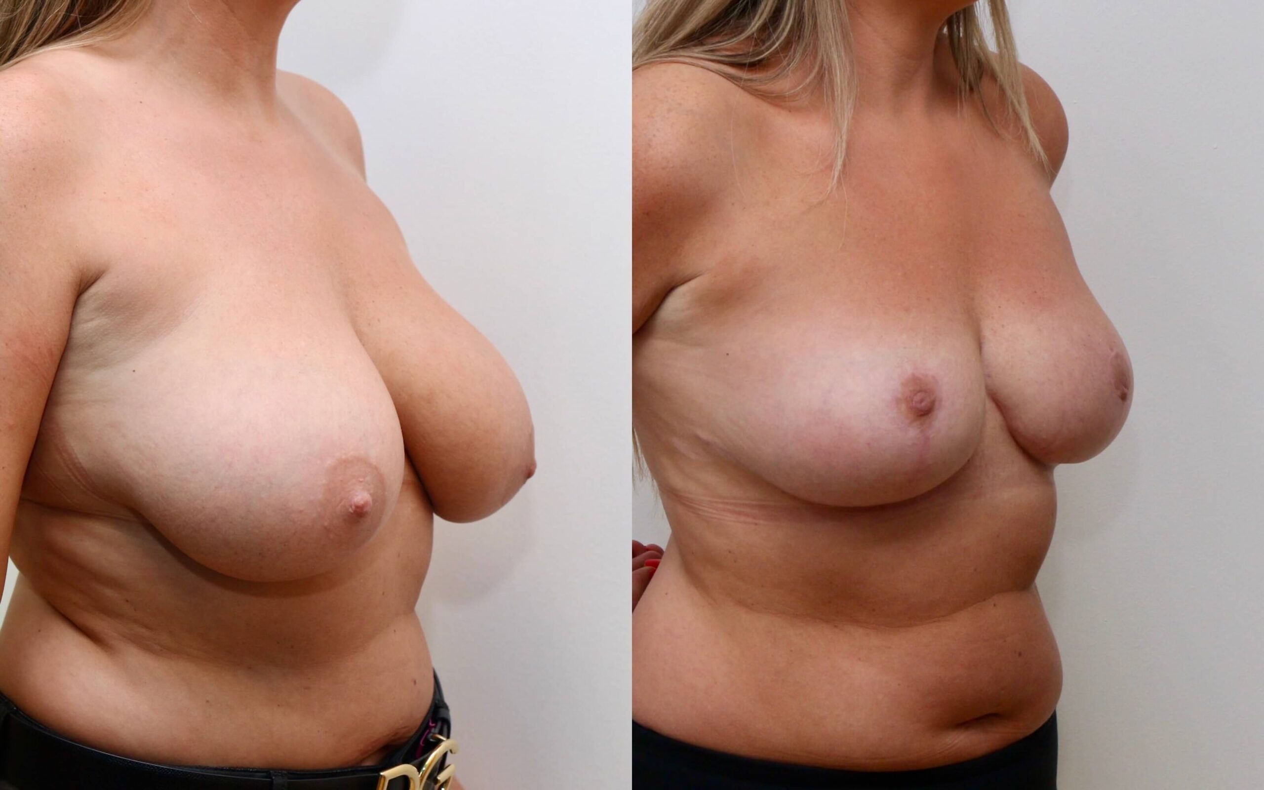 Breast uplift and correction of asymmetry