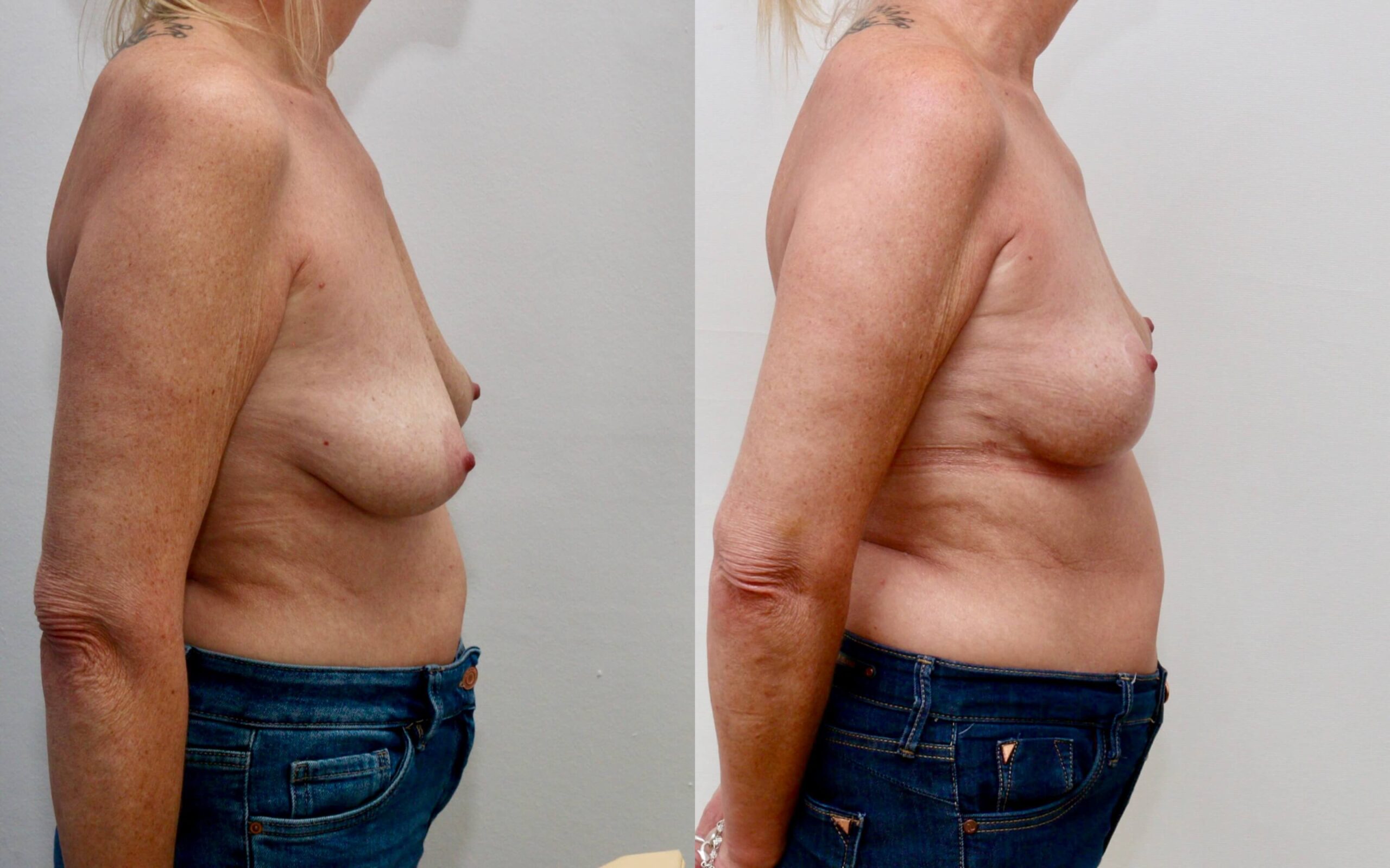 Breast uplift to improve shape