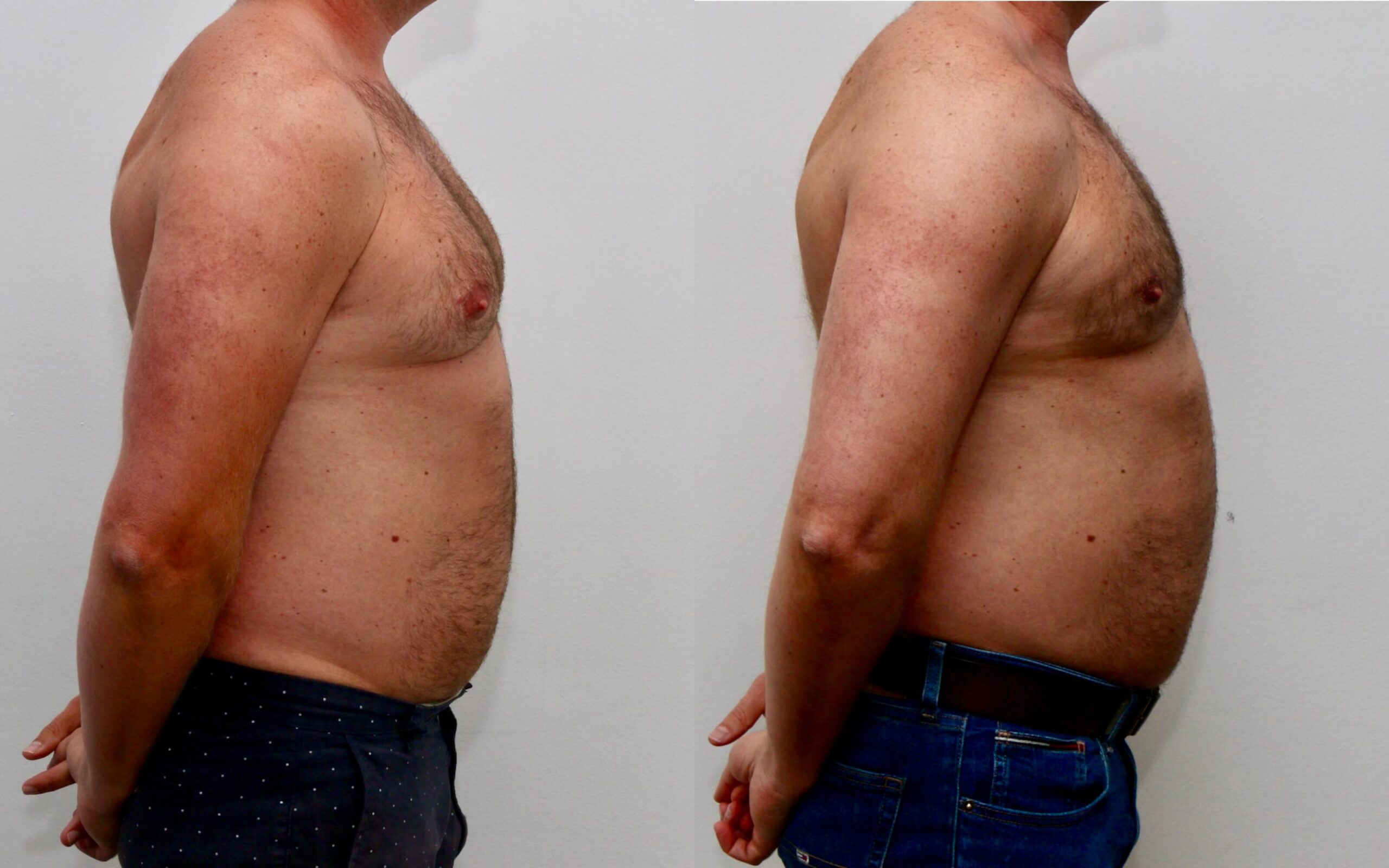 High volume liposuction for gynecomastia