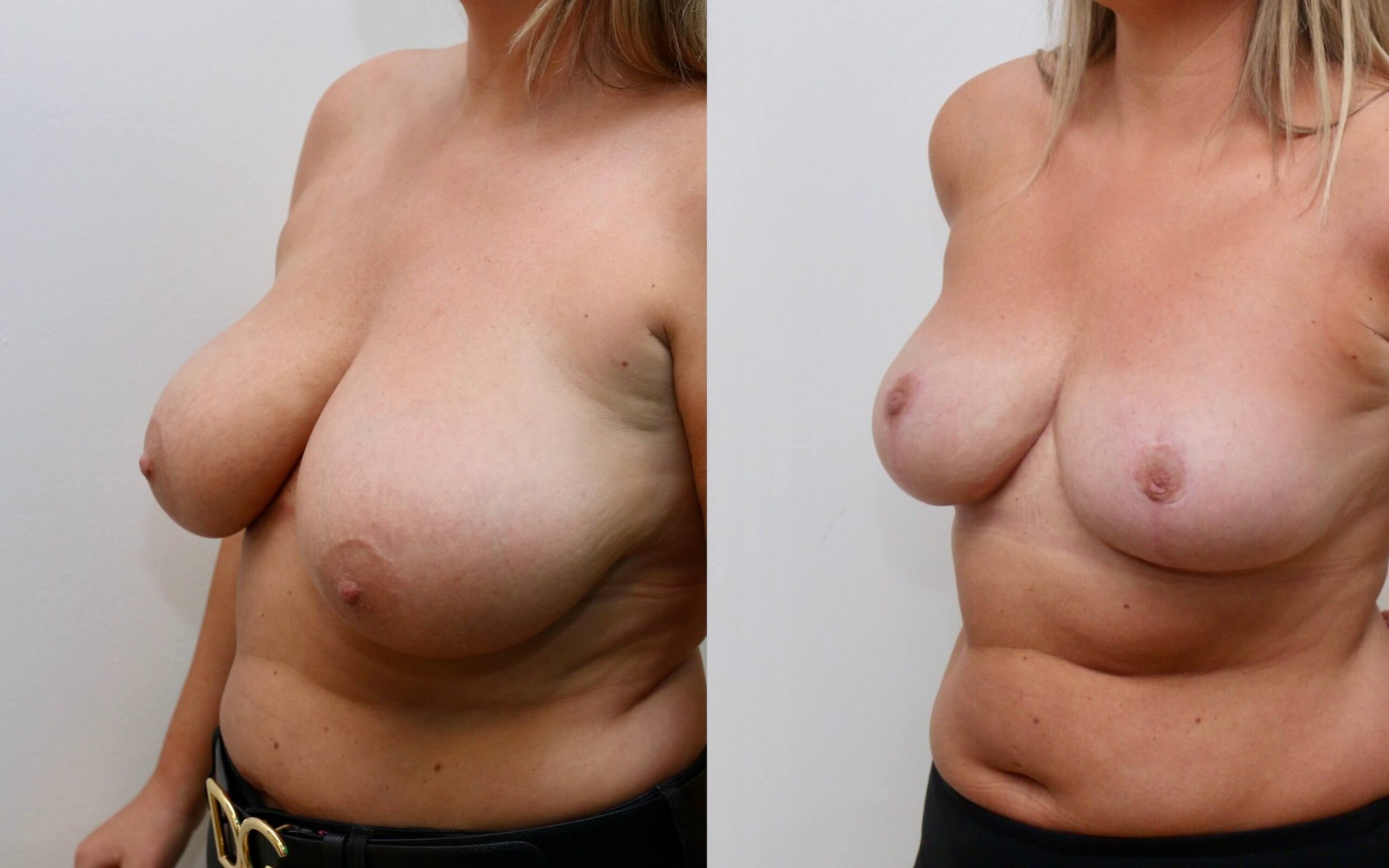 Breast uplift and correction of asymmetry