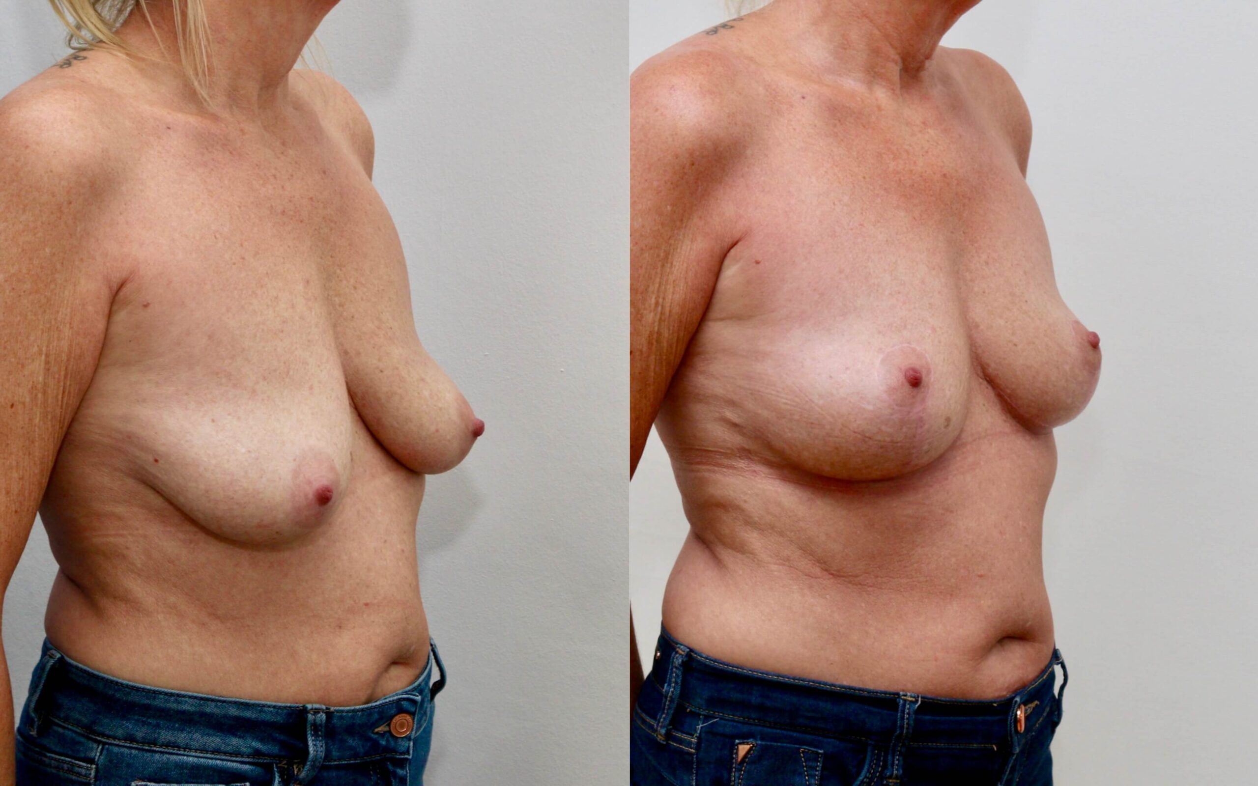 breast uplift edinburgh 50 year old