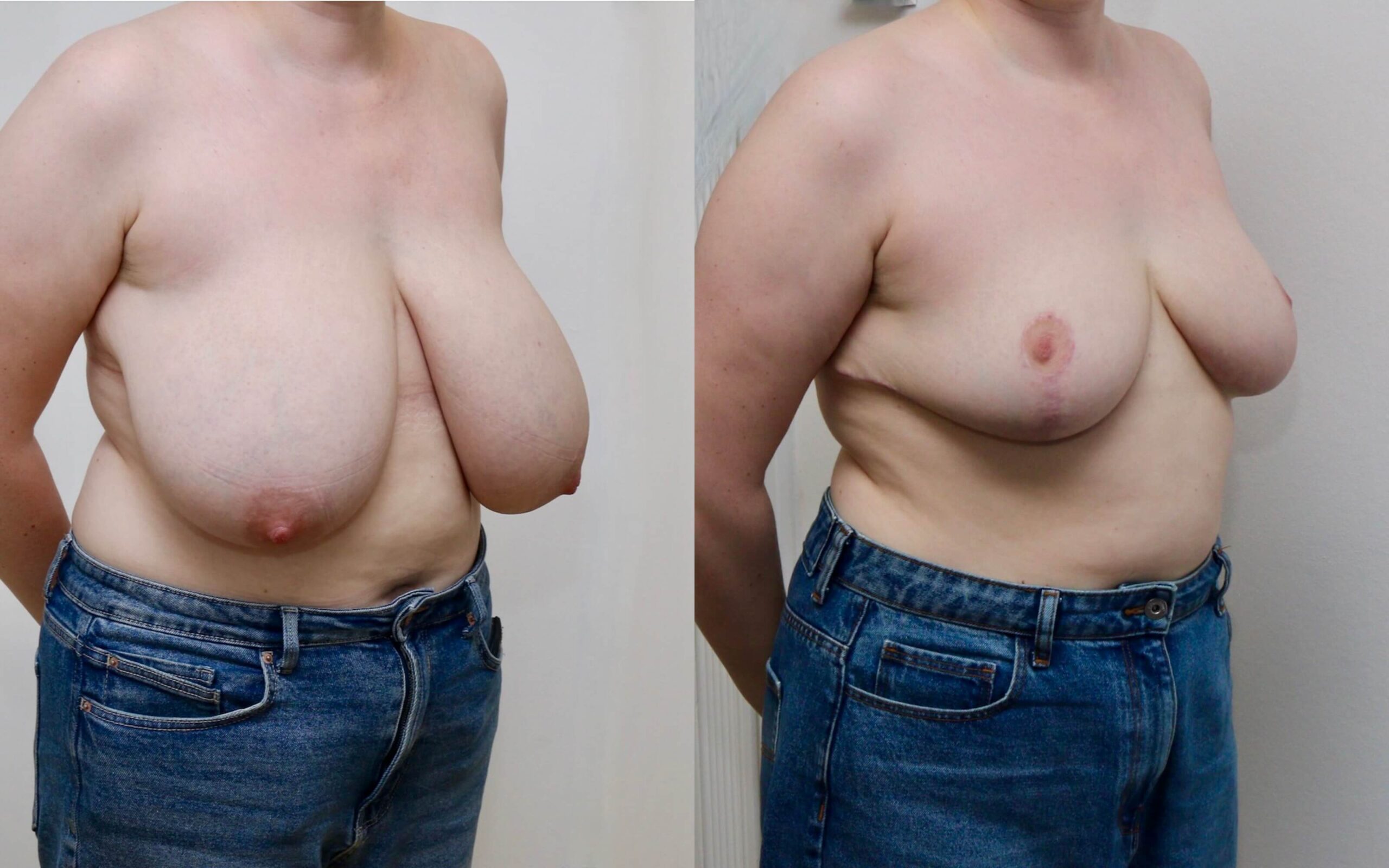 breast reduction edinburgh