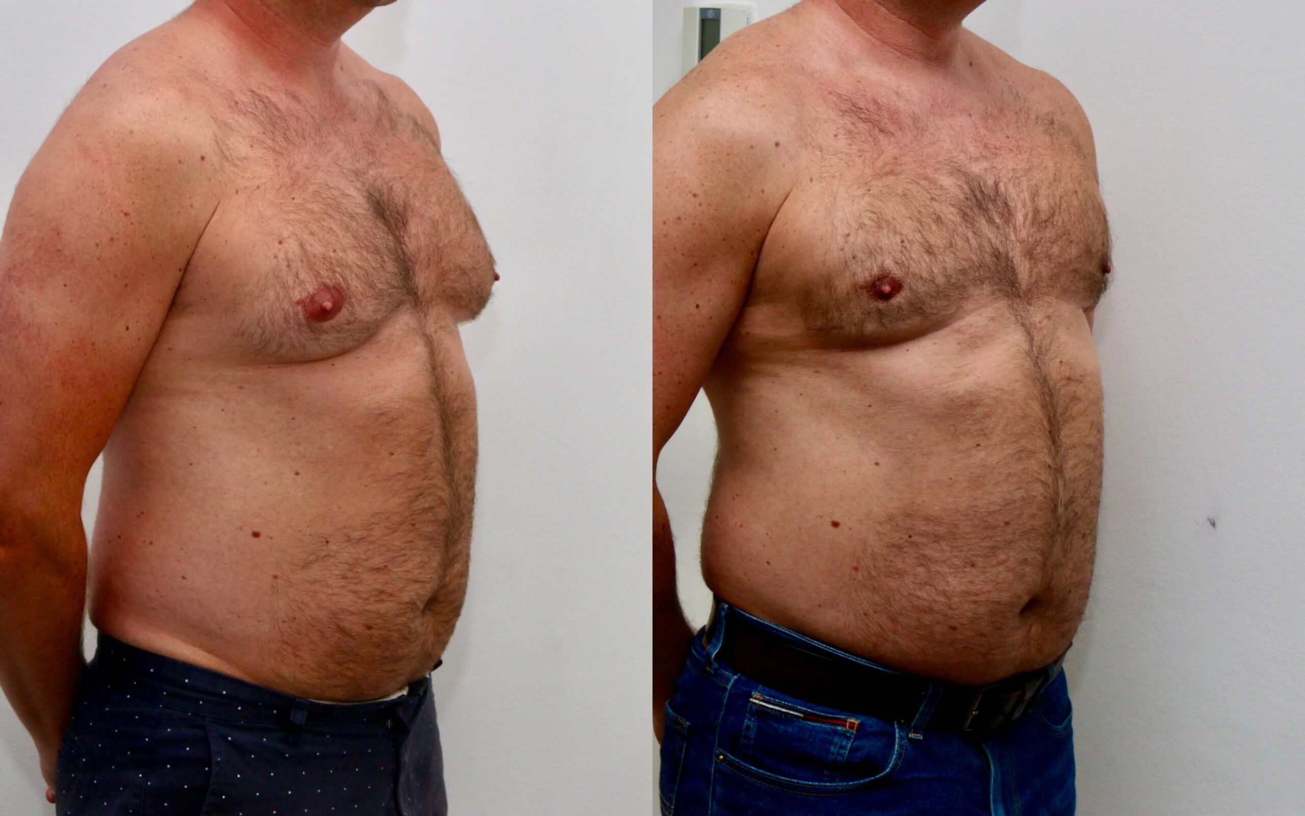 High volume liposuction for gynecomastia