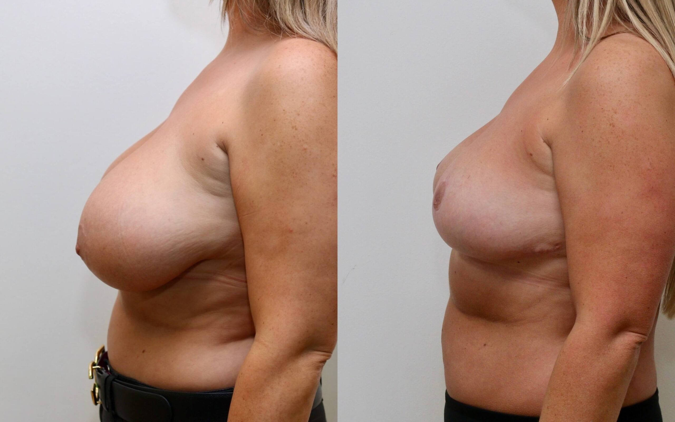 Breast uplift and correction of asymmetry