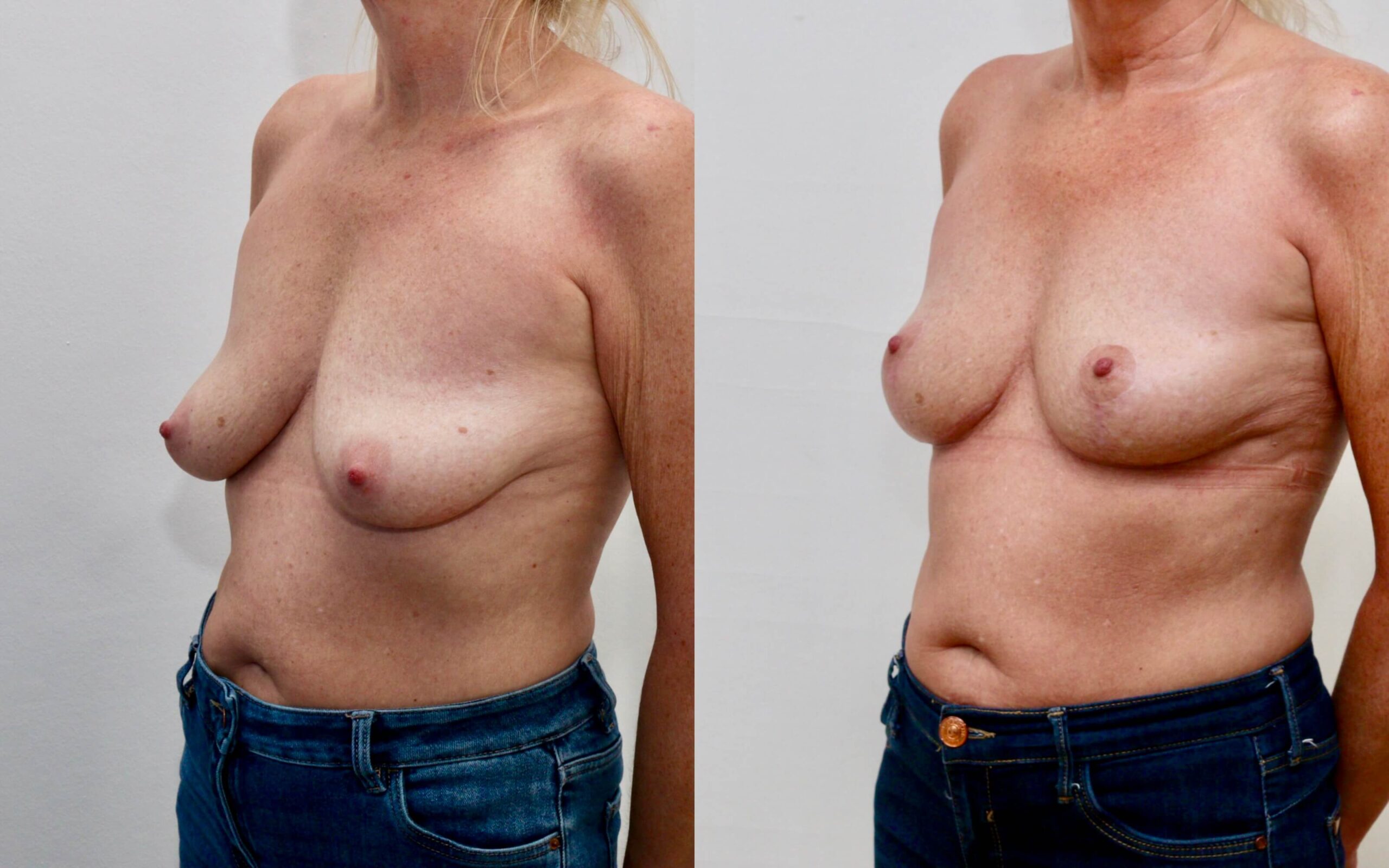 breast uplift three quarter view