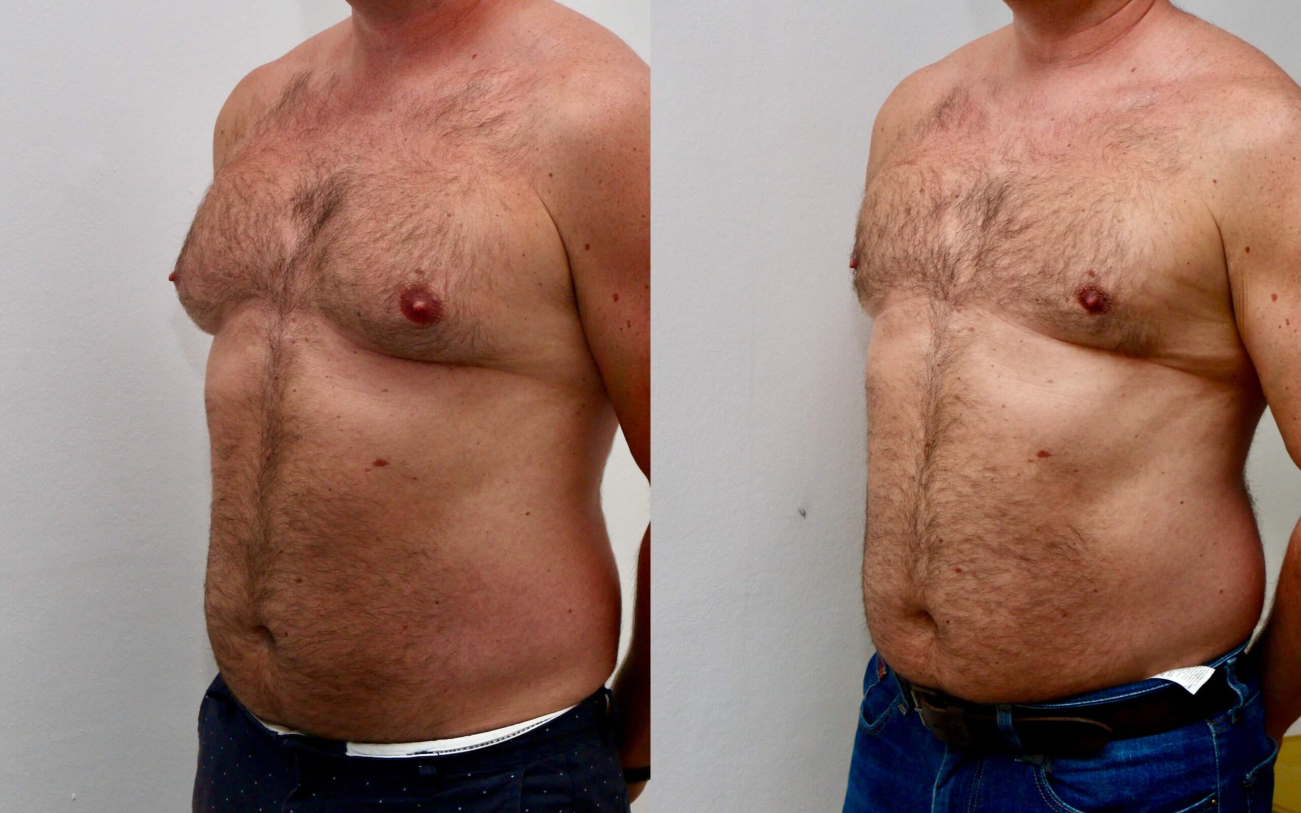 High volume liposuction for gynecomastia