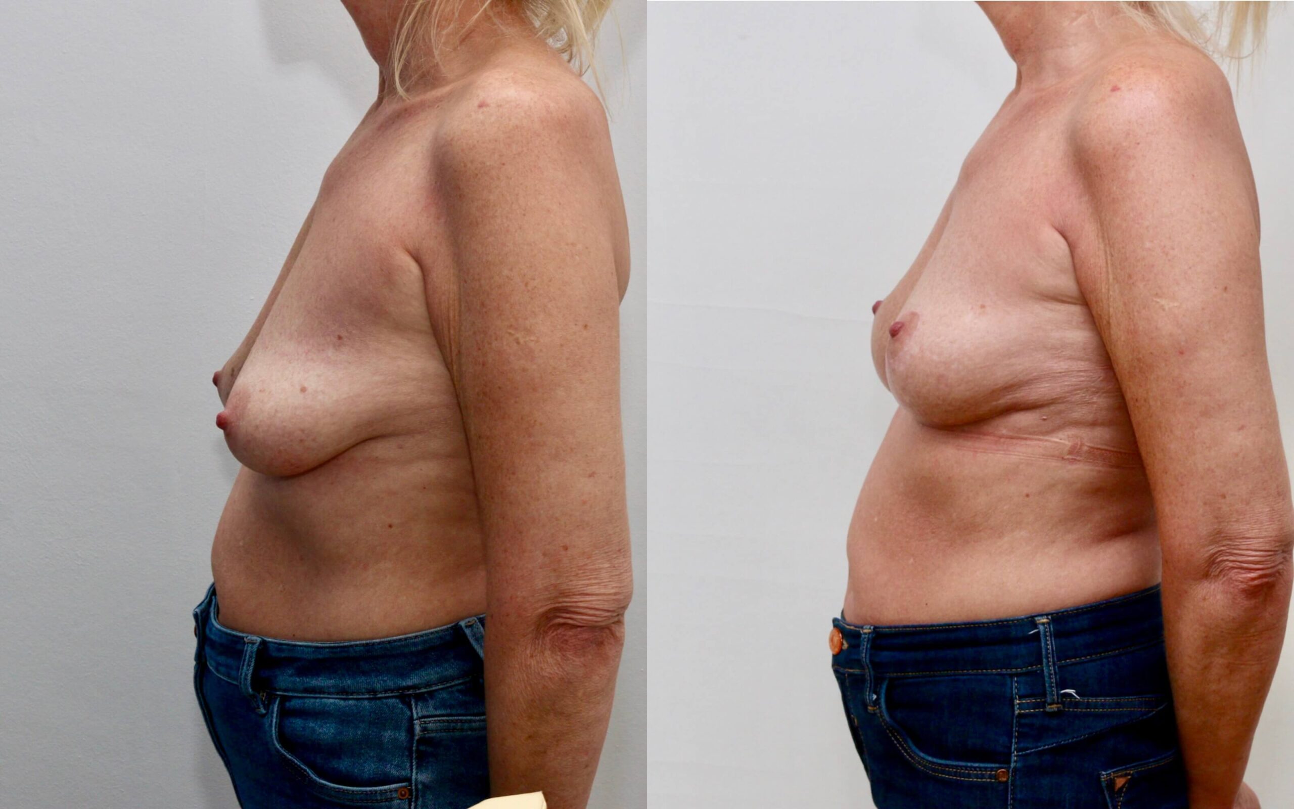 Breast uplift to improve shape