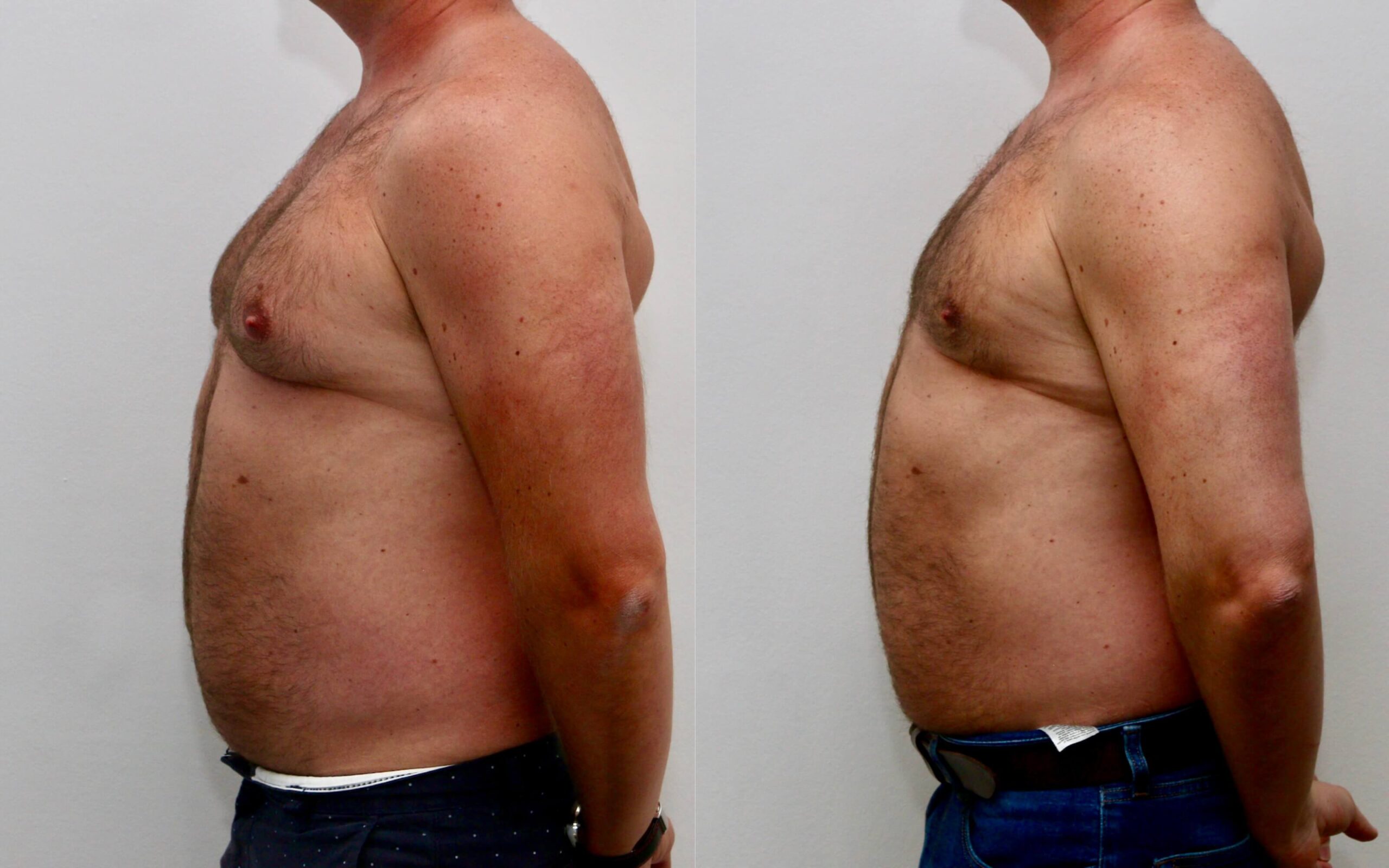 High volume liposuction for gynecomastia