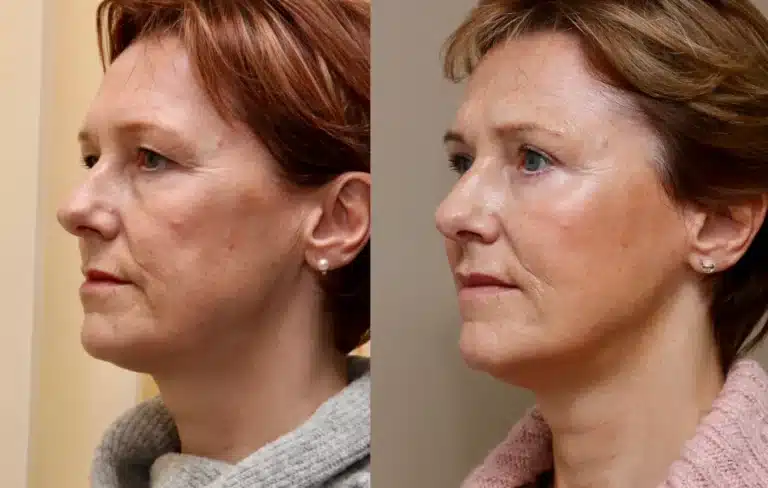 neck liposuction fat transfer to cheeks scotland