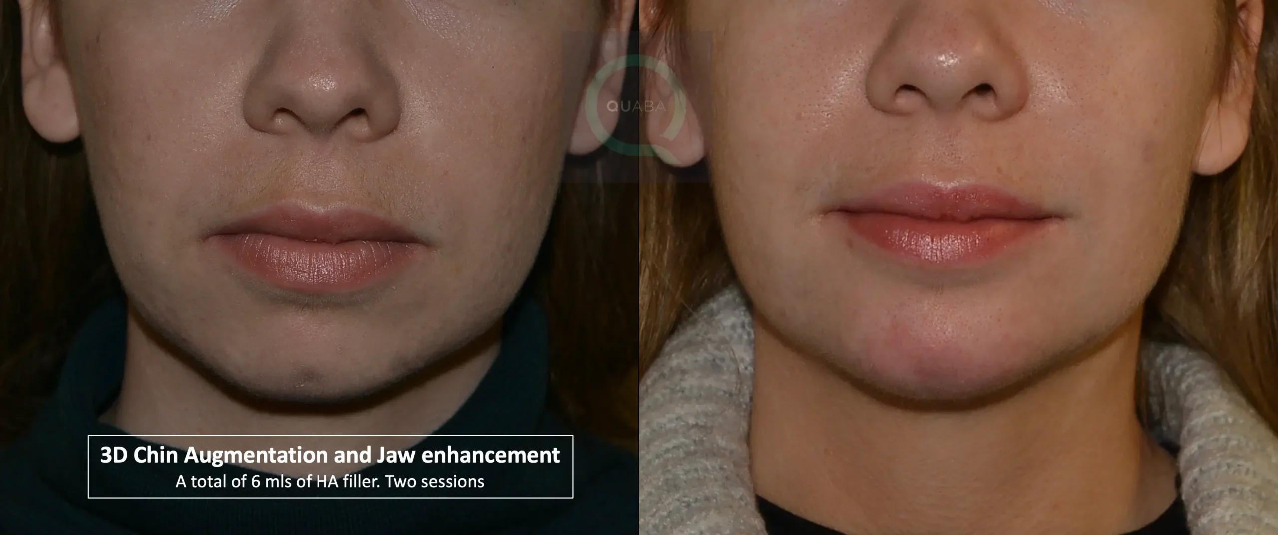 chin enhancment using fillers