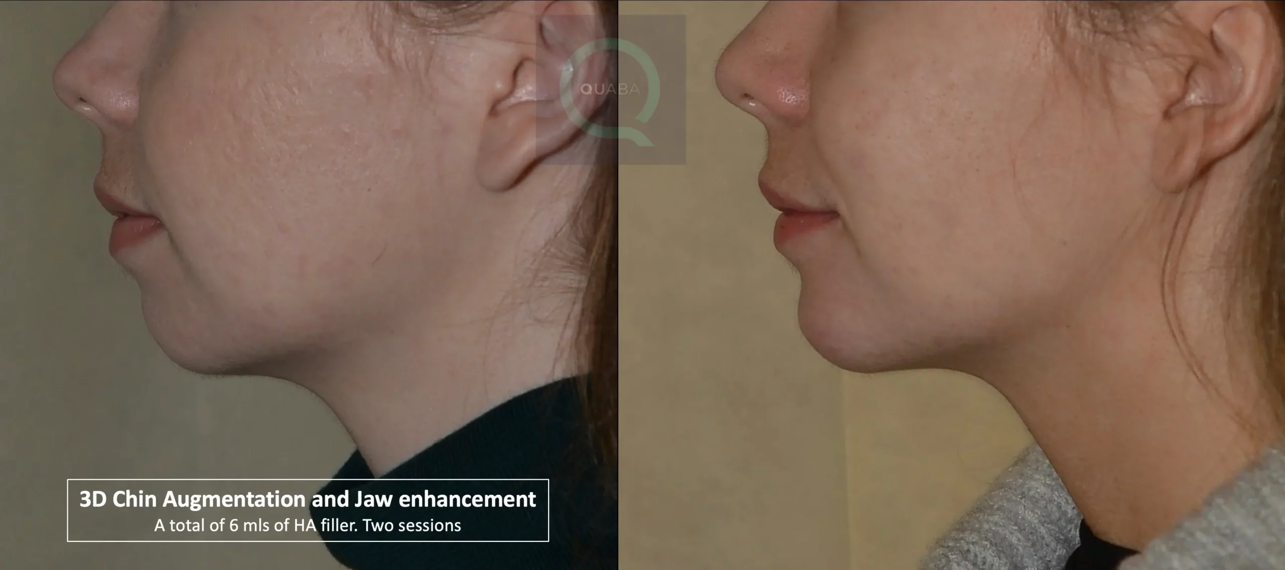 chin enhancment using fillers