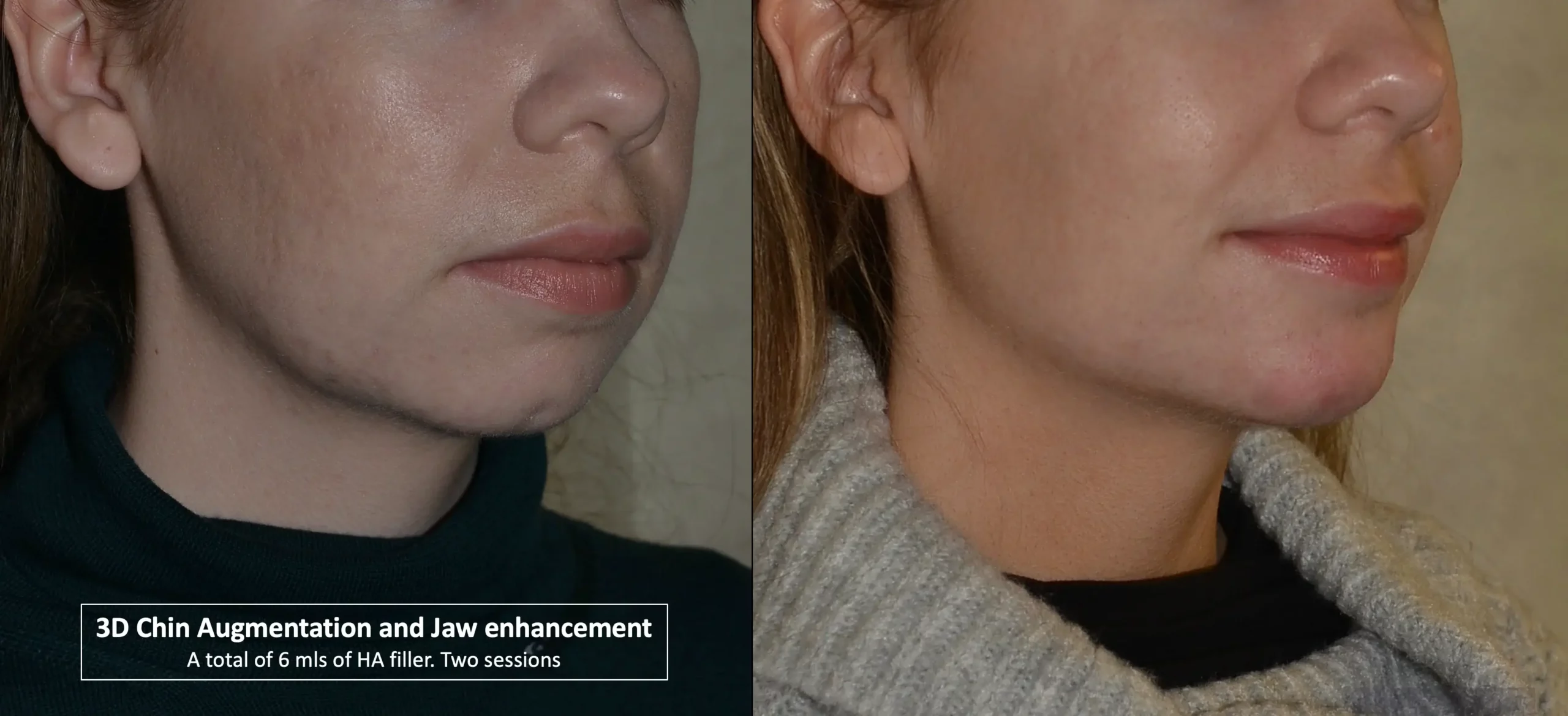 chin fillers edinburgh