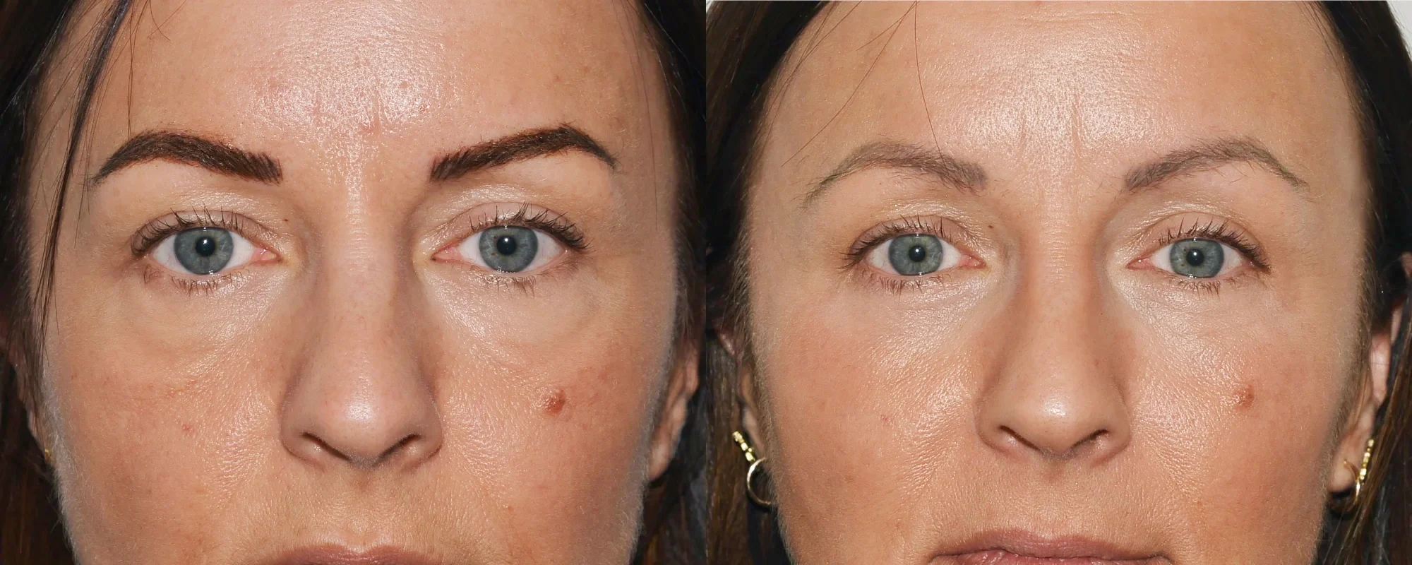 lower blepharoplasty scotland