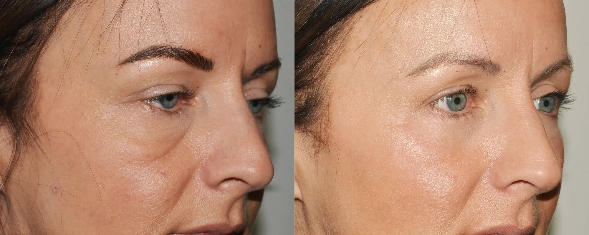 lower eyelids surgery scotland