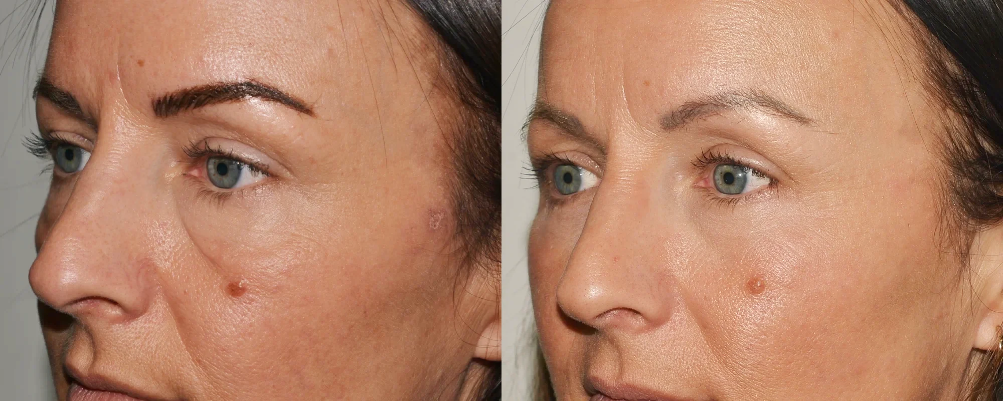 eyebag removal edinburgh before and after
