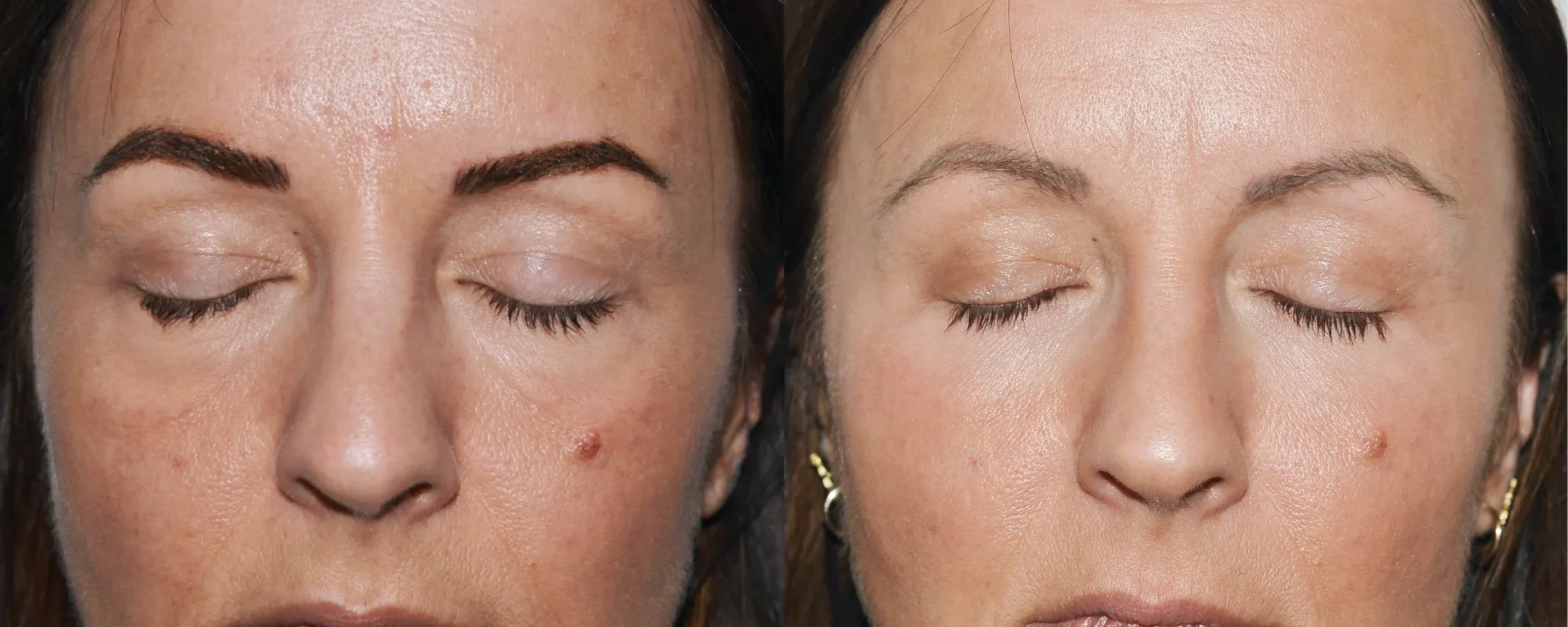 lower eyelid surgery scotland