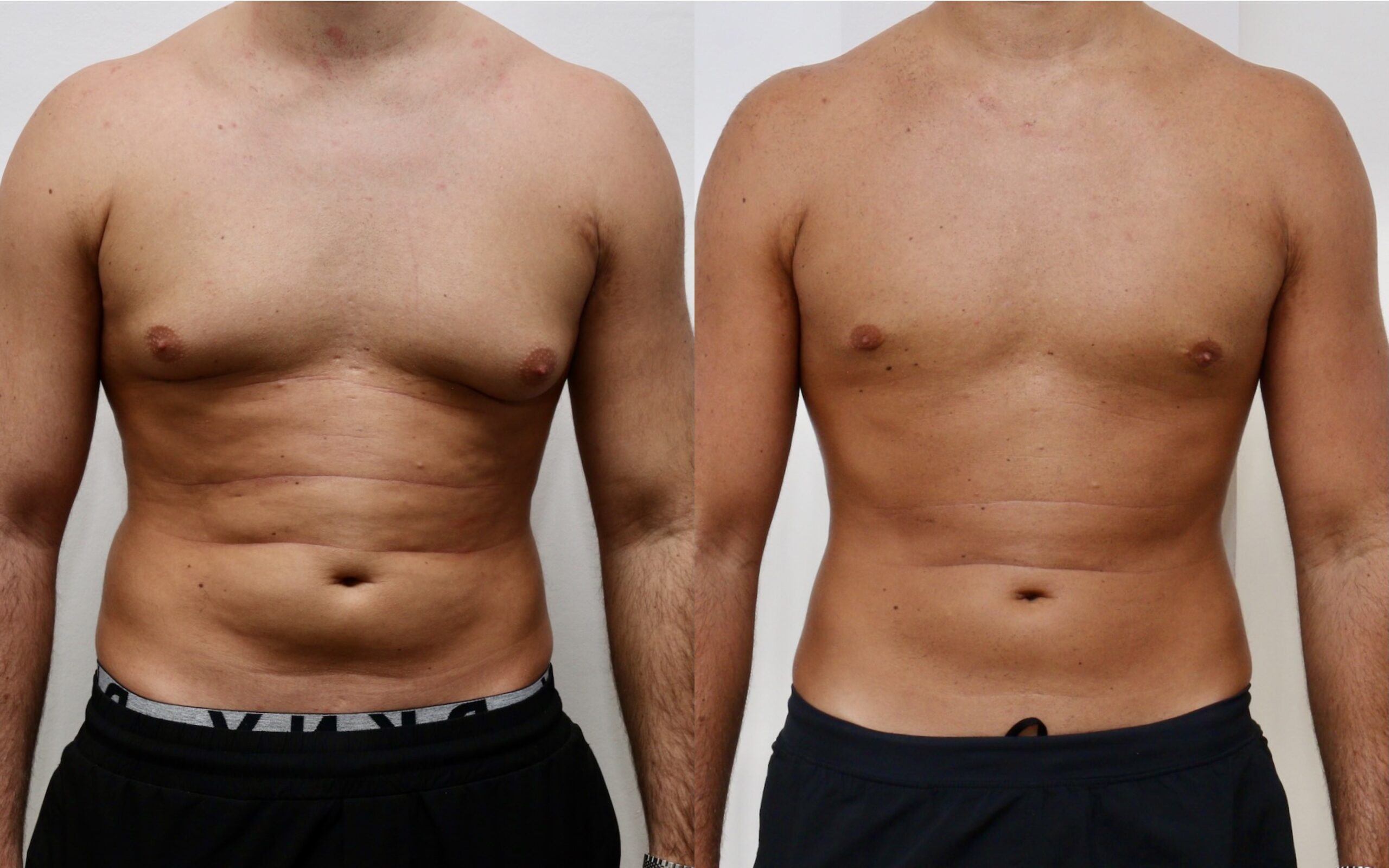 Excision of localised glandular gynecomastia - no skin excision