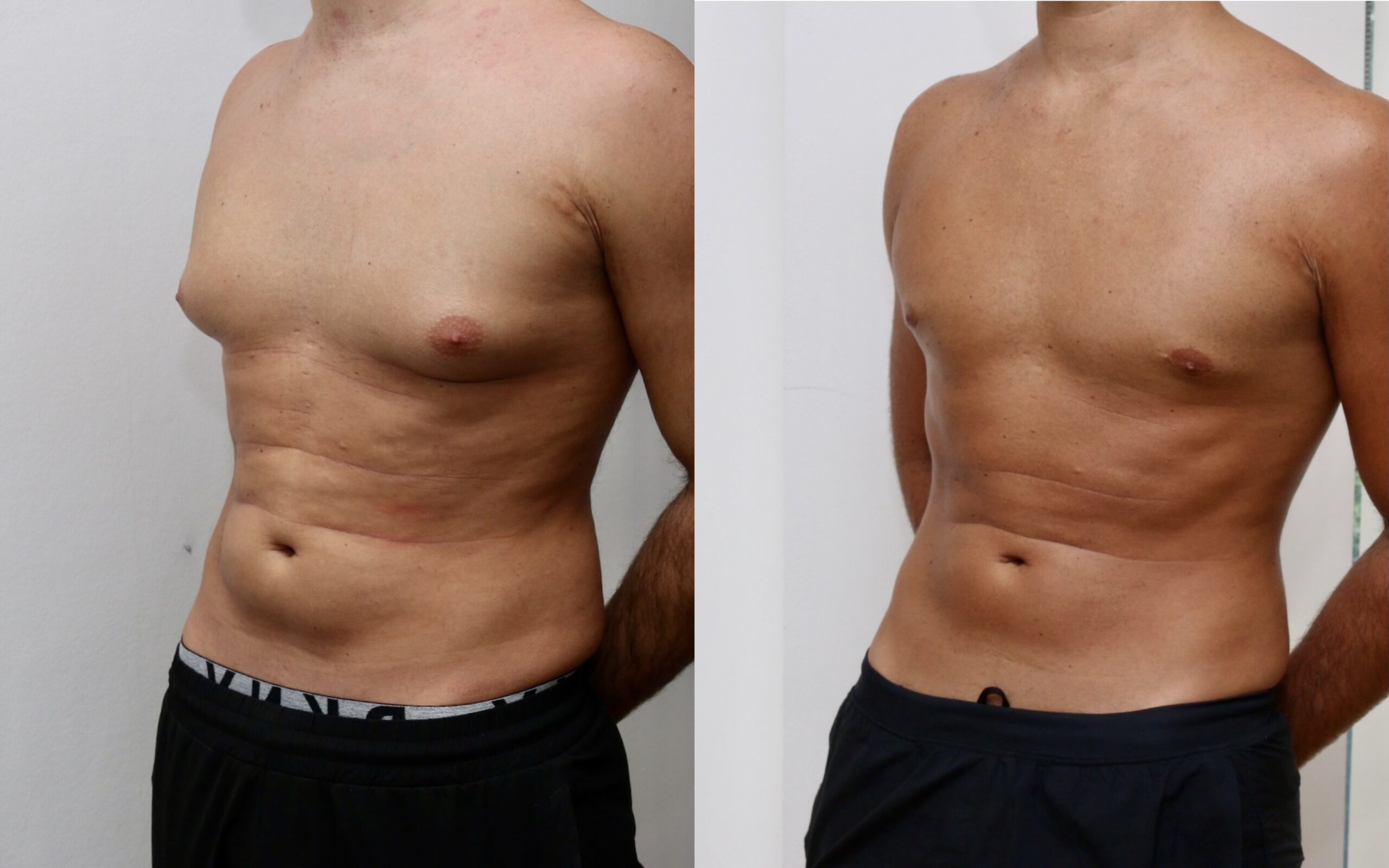 Excision of localised glandular gynecomastia - no skin excision