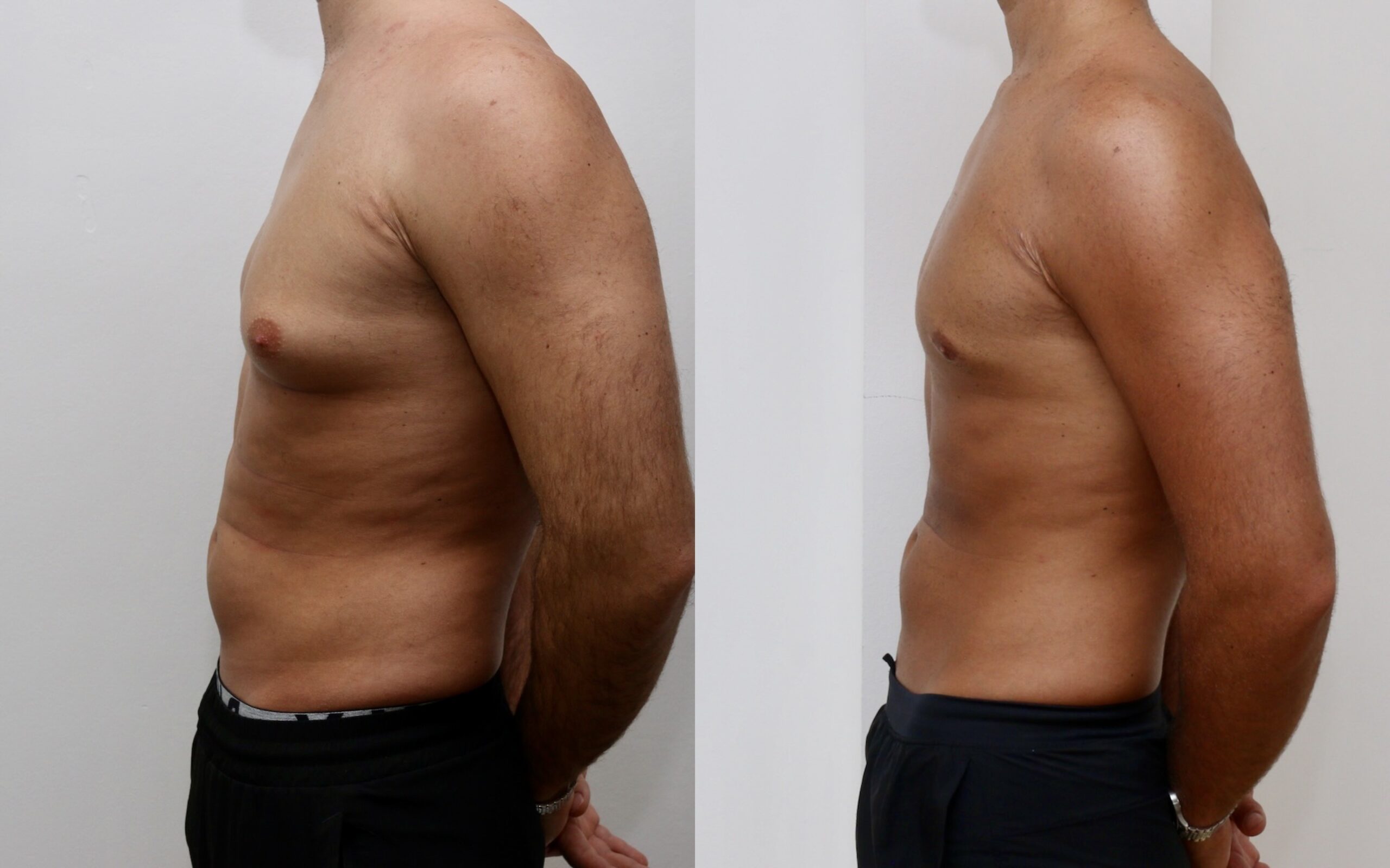 Excision of localised glandular gynecomastia - no skin excision