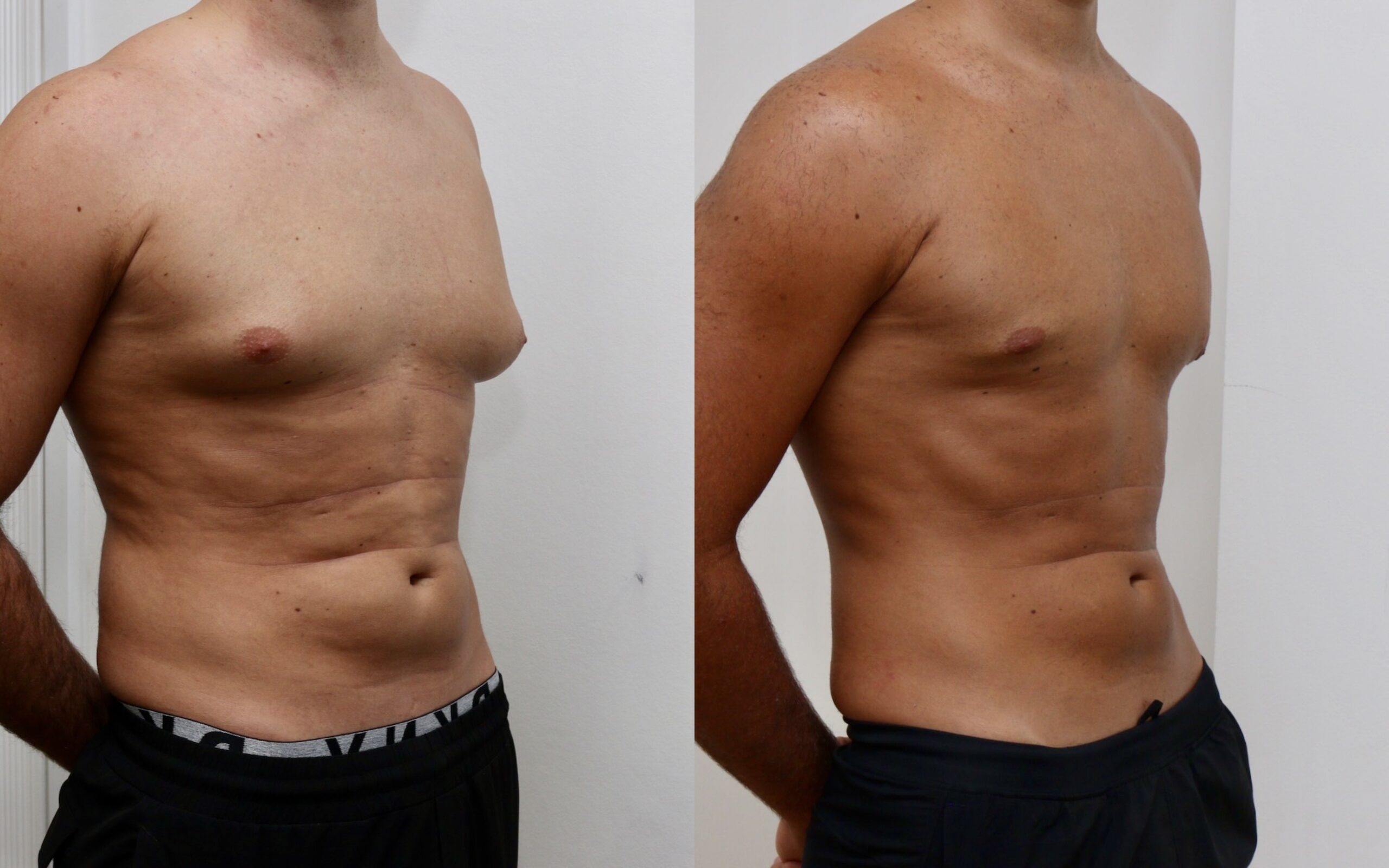 Excision of localised glandular gynecomastia - no skin excision