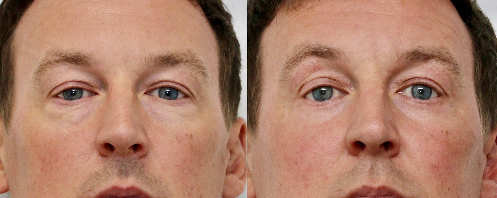 eye bag removal scotland