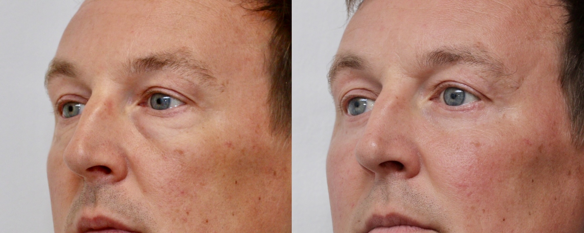 eyebag removal edinburgh