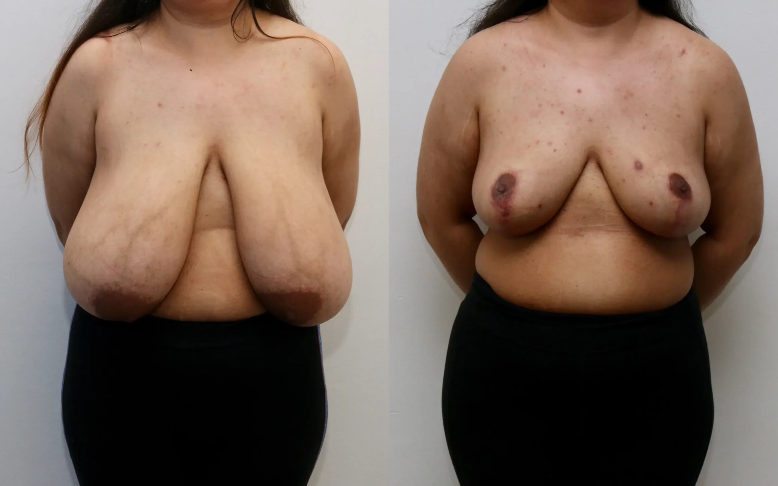 huge breast reduction and breast lift