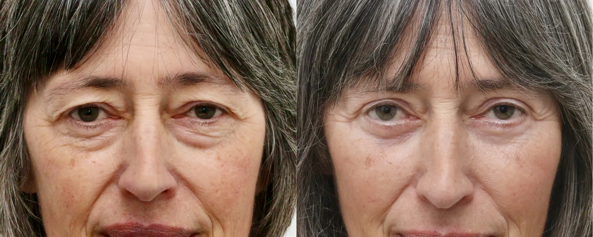 eyebag removal scotland