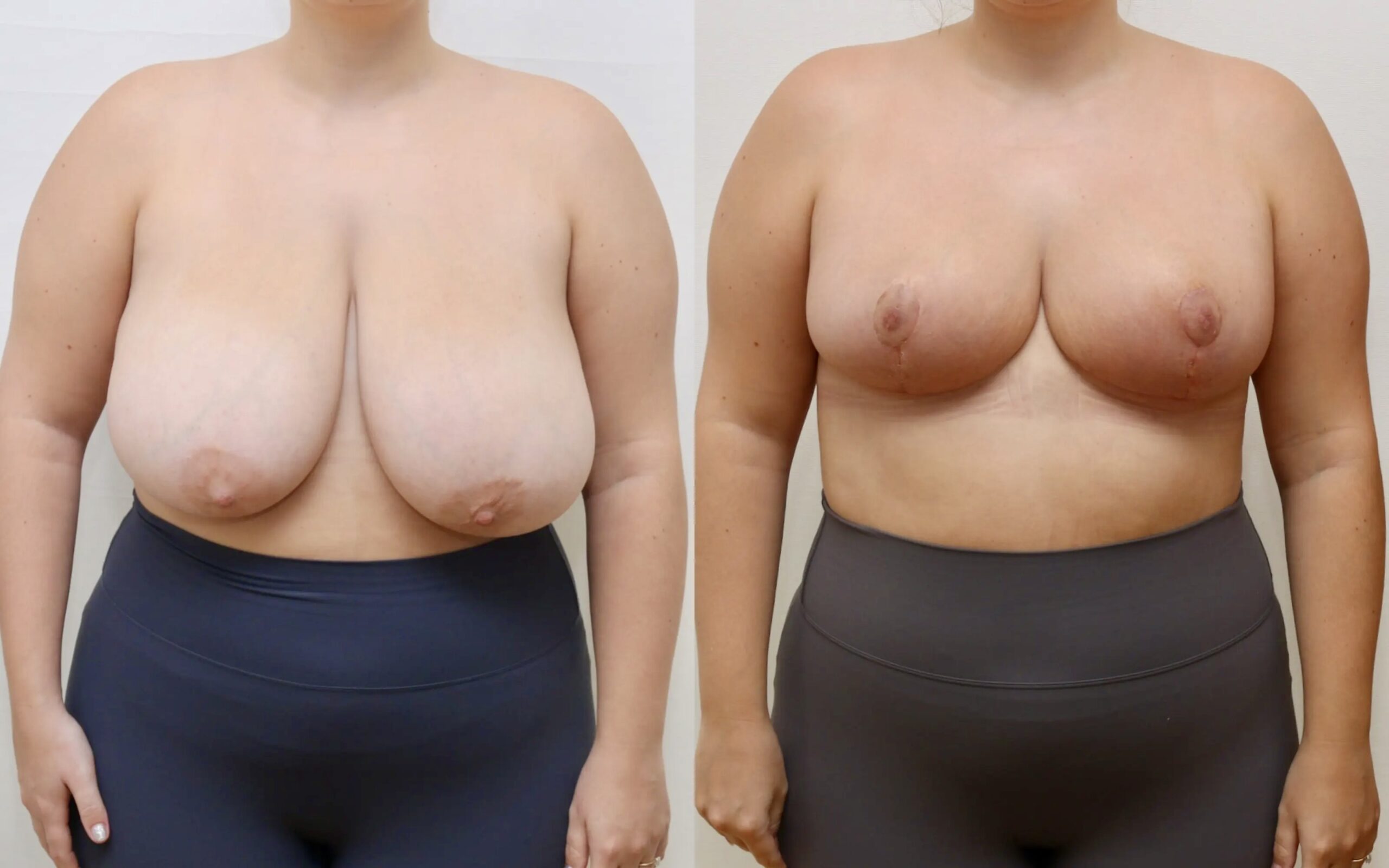 breast reduction before and after 4 weeks