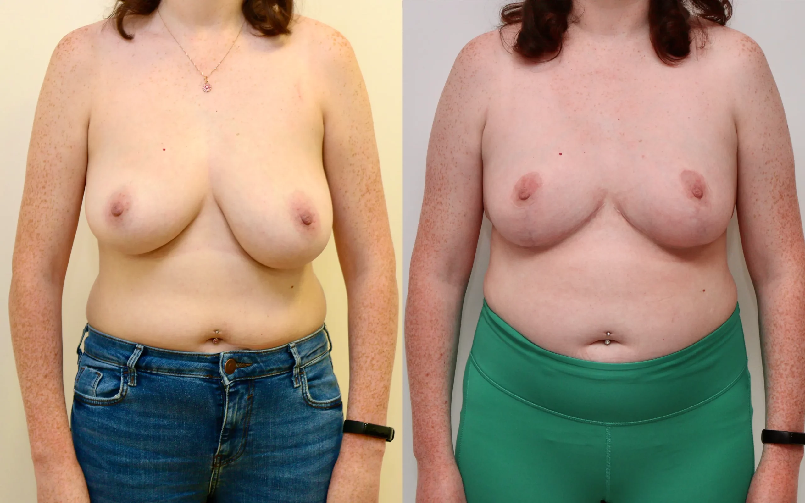 breast uplift for asymmetry