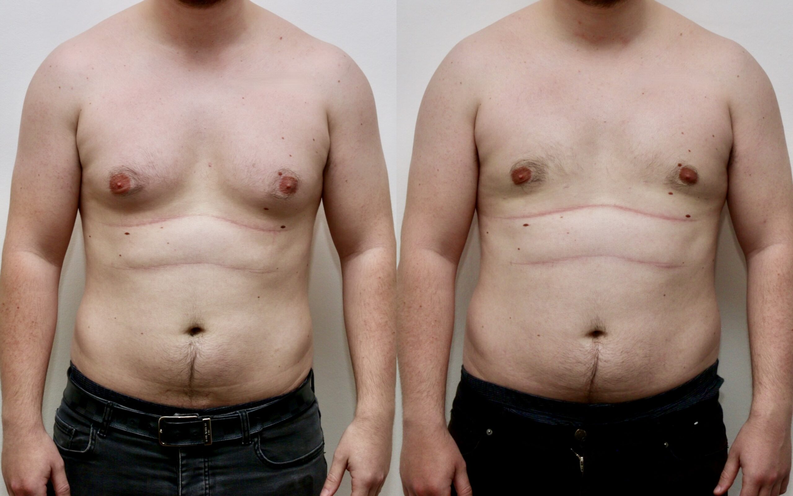 gynecomastia edinburgh