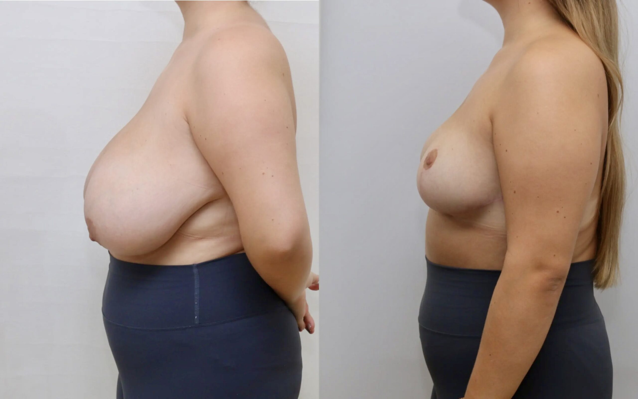 breast reduction before and after 6 months