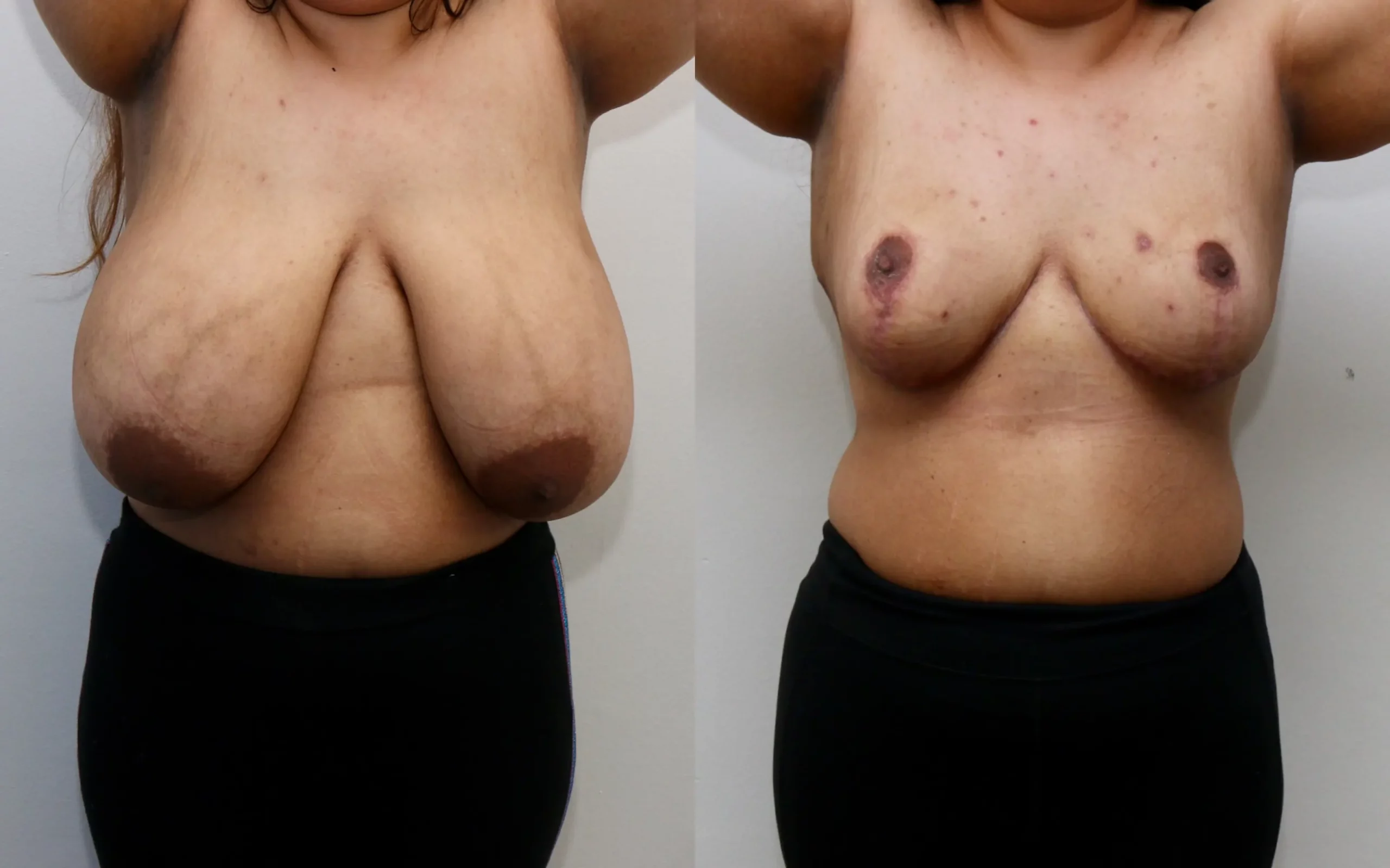 Large breast reduction