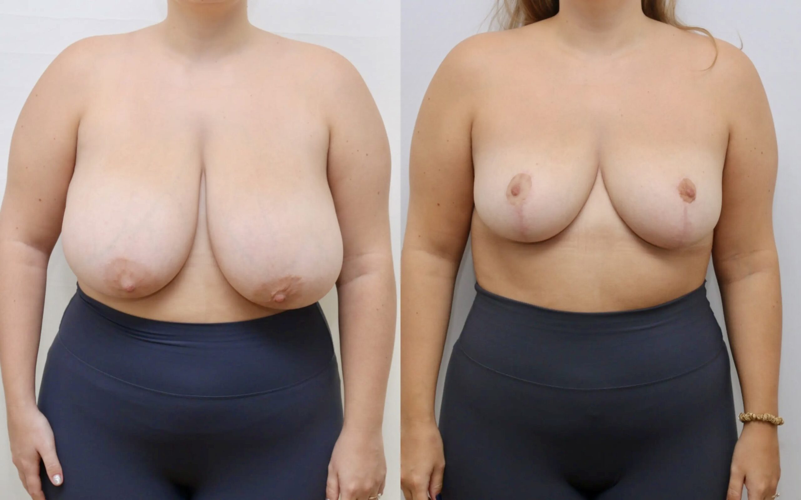 breast reduction before and after 6 months