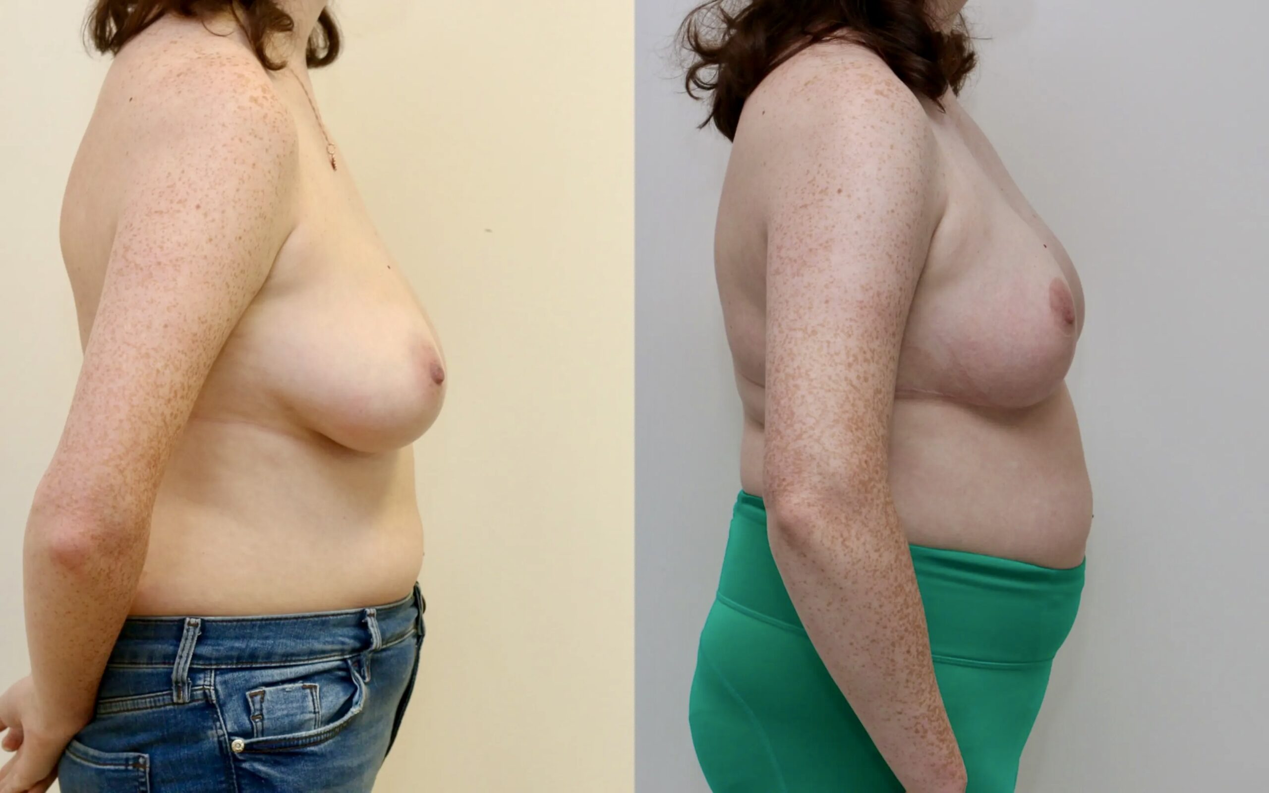 Breast uplift/ reduction for breast asymmetry