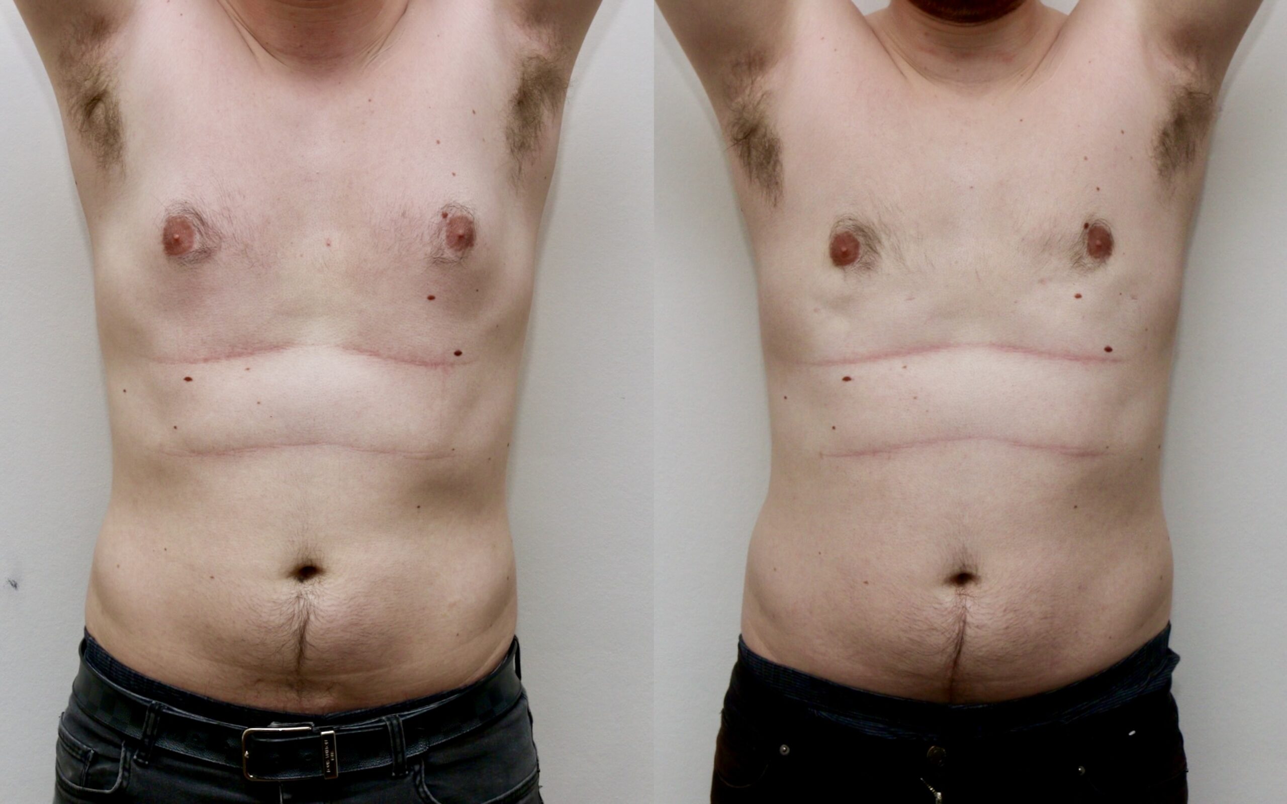 Standard liposuction only gynecomastia correction