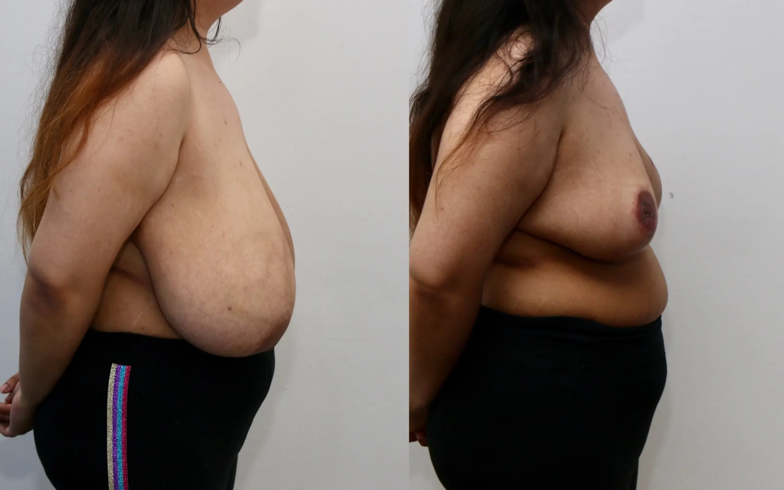 Large breast reduction